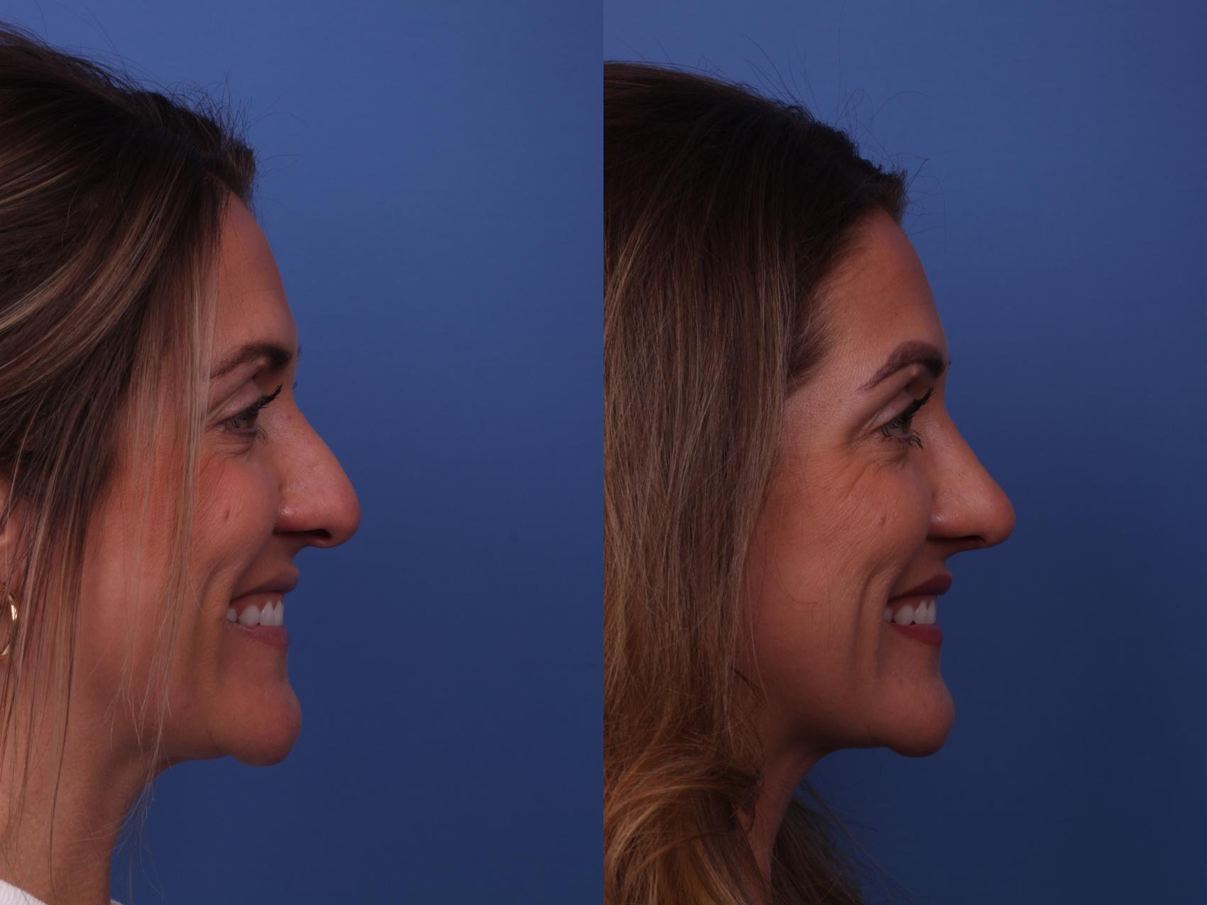 Before & After Rhinoplasty Case 322 View #2 View in Scottsdale, AZ