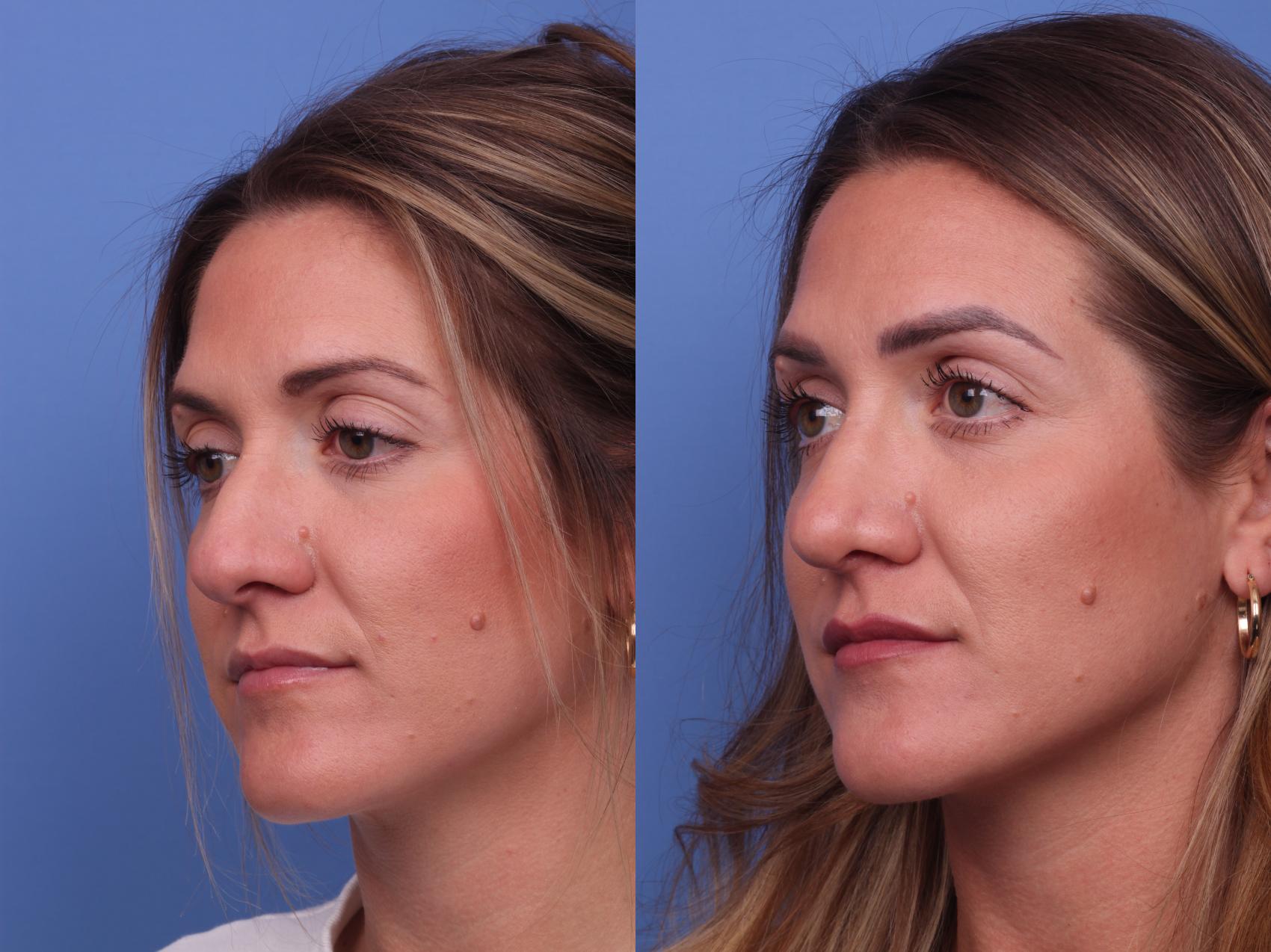 Before & After Rhinoplasty Case 322 View #3 View in Scottsdale, AZ