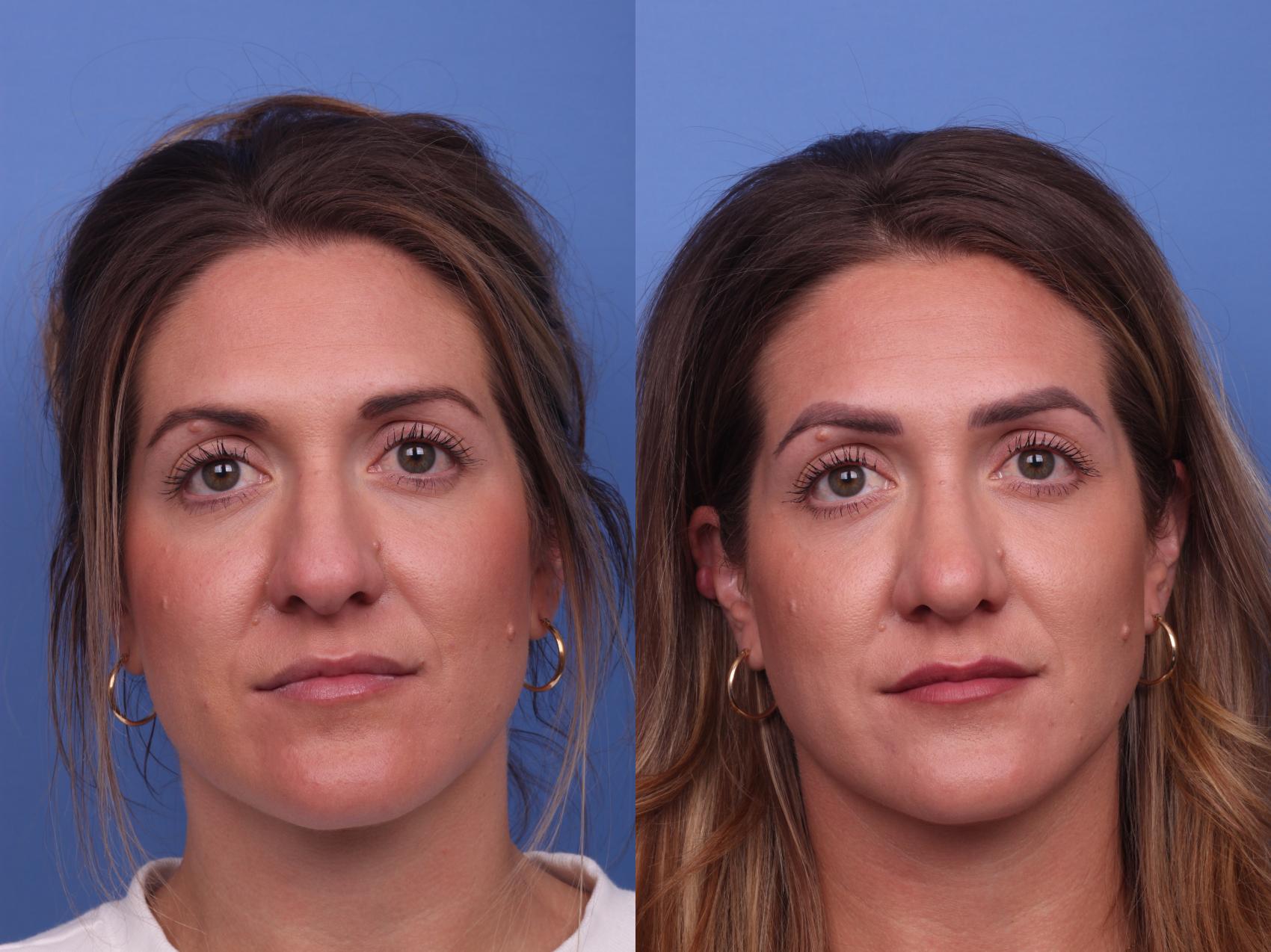 Before & After Rhinoplasty Case 322 View #4 View in Scottsdale, AZ