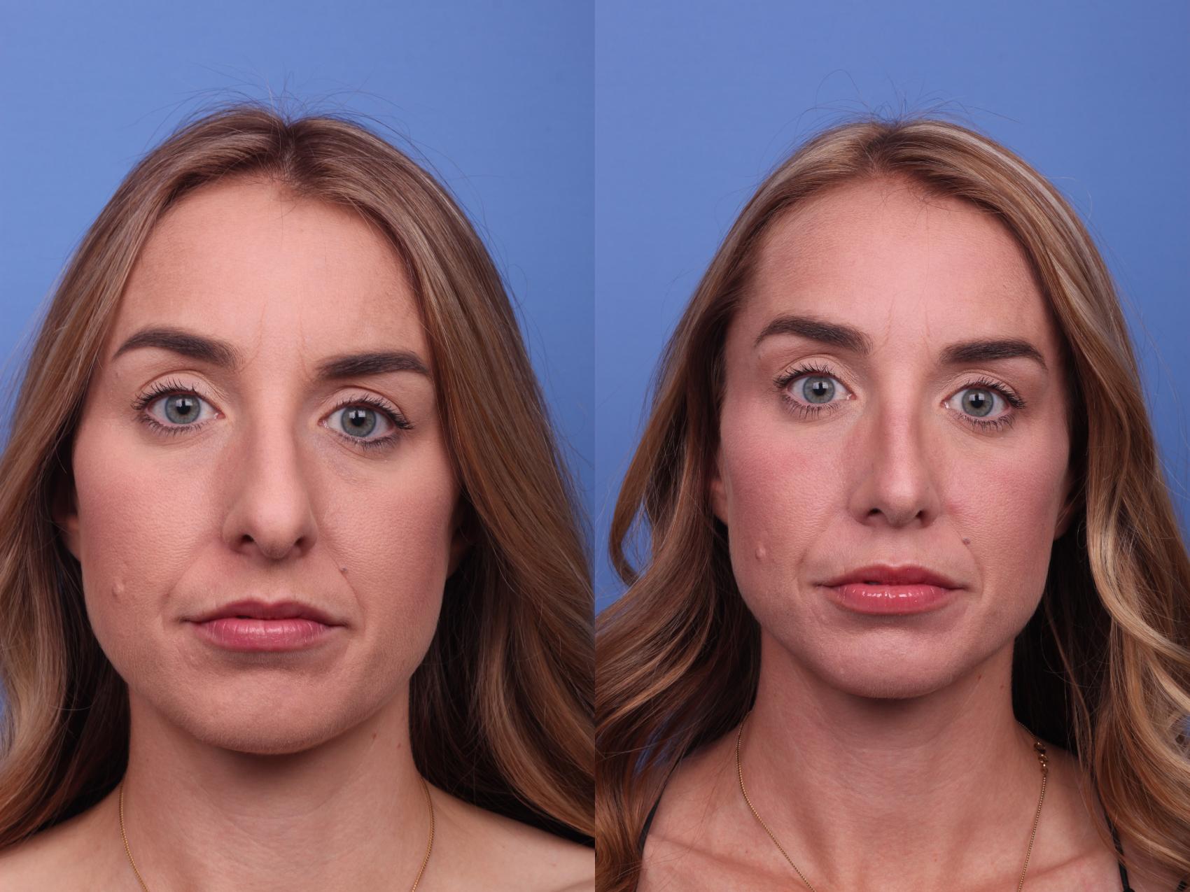 Before & After Rhinoplasty Case 323 View #2 View in Scottsdale, AZ