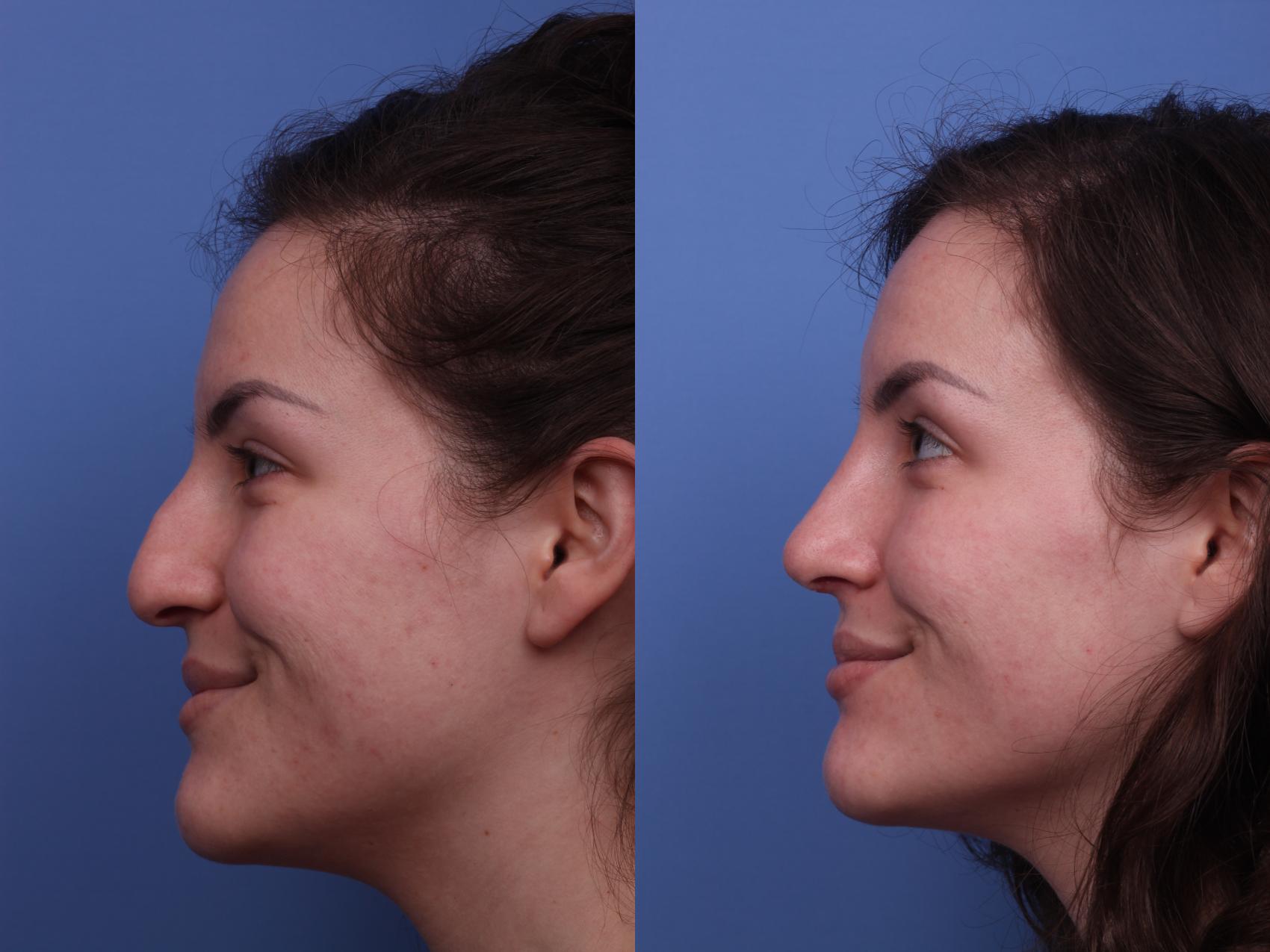 Before & After Rhinoplasty Case 324 View #2 View in Scottsdale, AZ