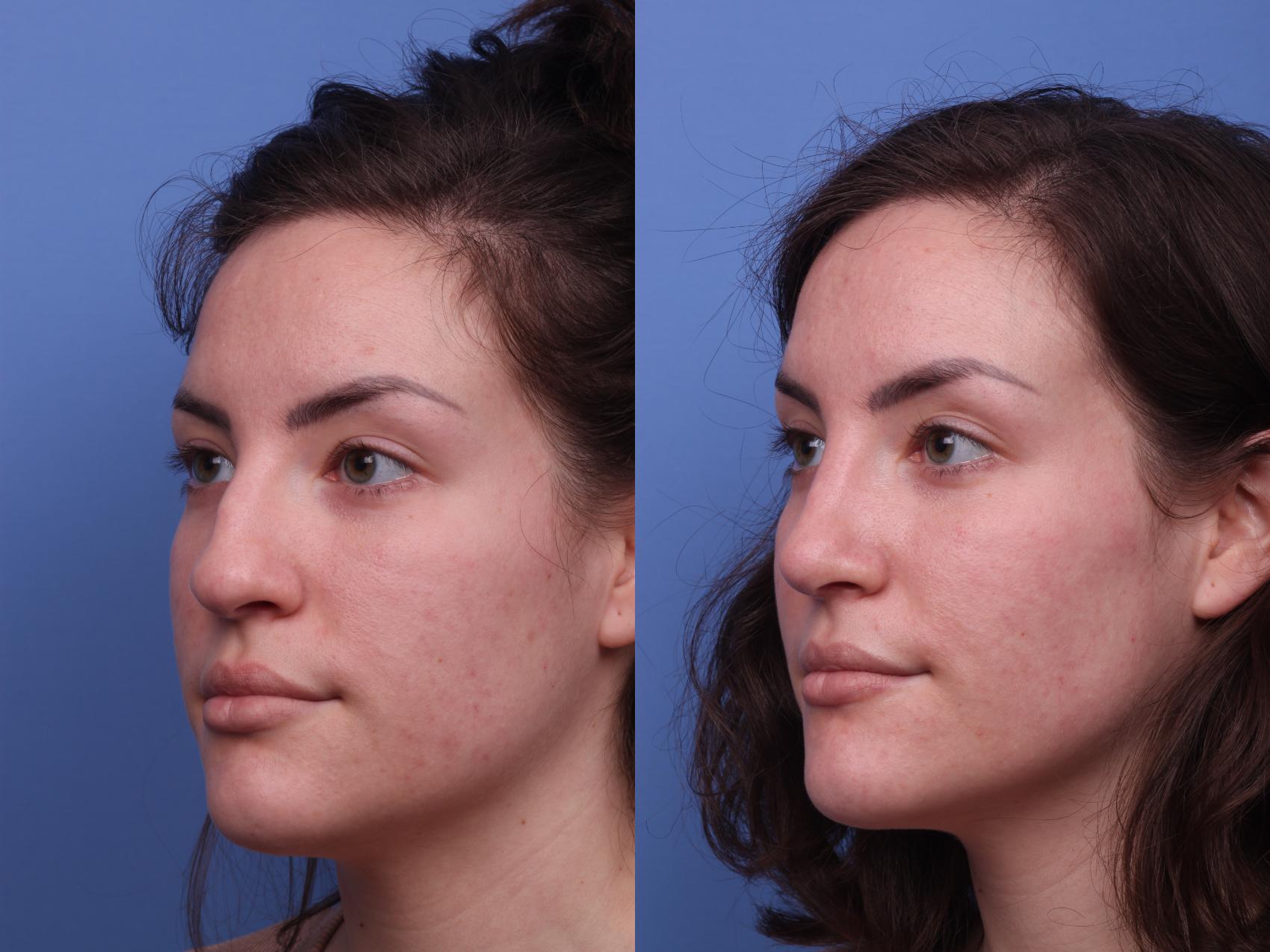 Before & After Rhinoplasty Case 324 View #3 View in Scottsdale, AZ