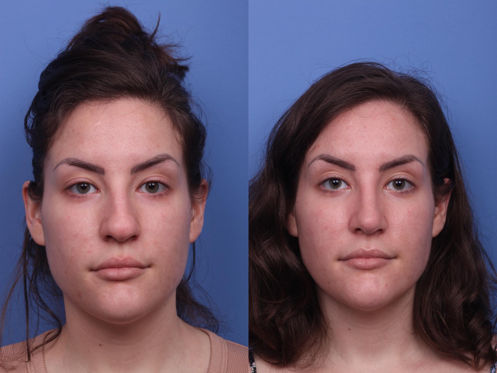 Before & After Rhinoplasty Case 324 View #4 View in Scottsdale, AZ