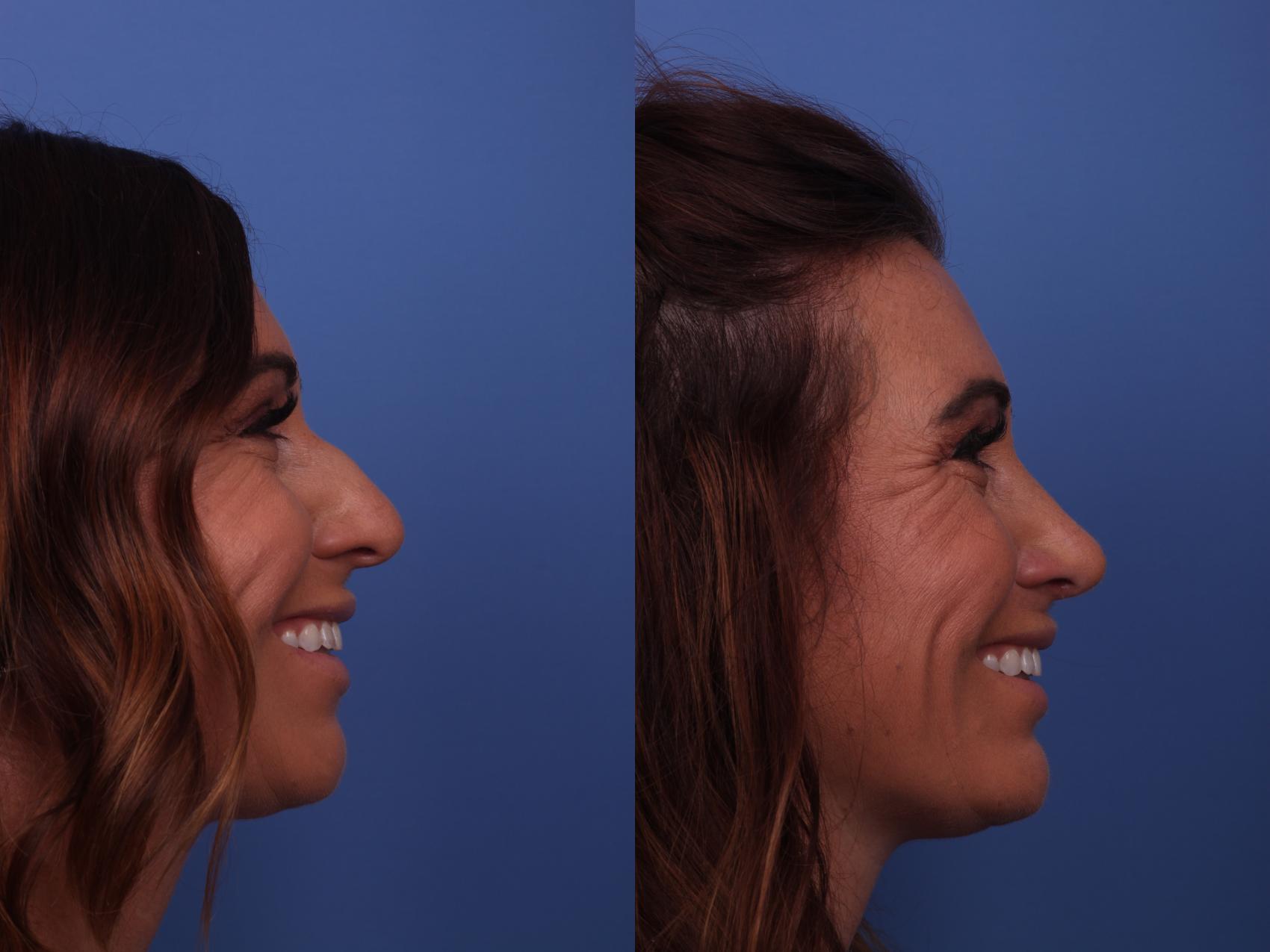 Before & After Rhinoplasty Case 325 View #2 View in Scottsdale, AZ