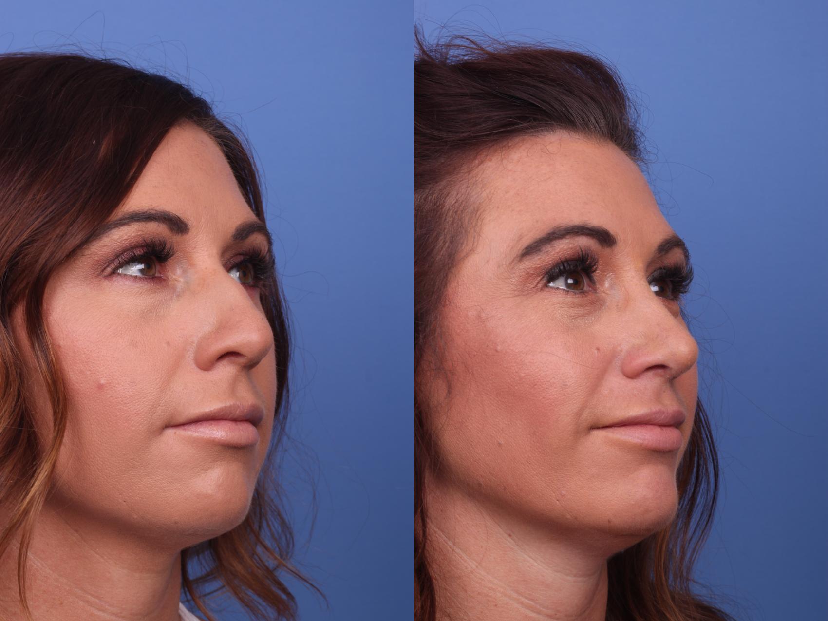 Before & After Rhinoplasty Case 325 View #3 View in Scottsdale, AZ