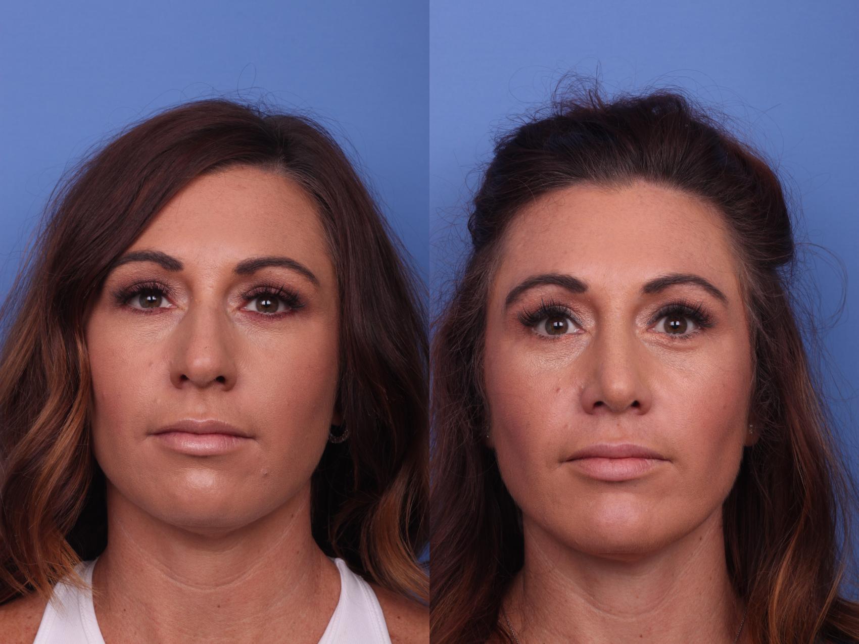 Before & After Rhinoplasty Case 325 View #4 View in Scottsdale, AZ