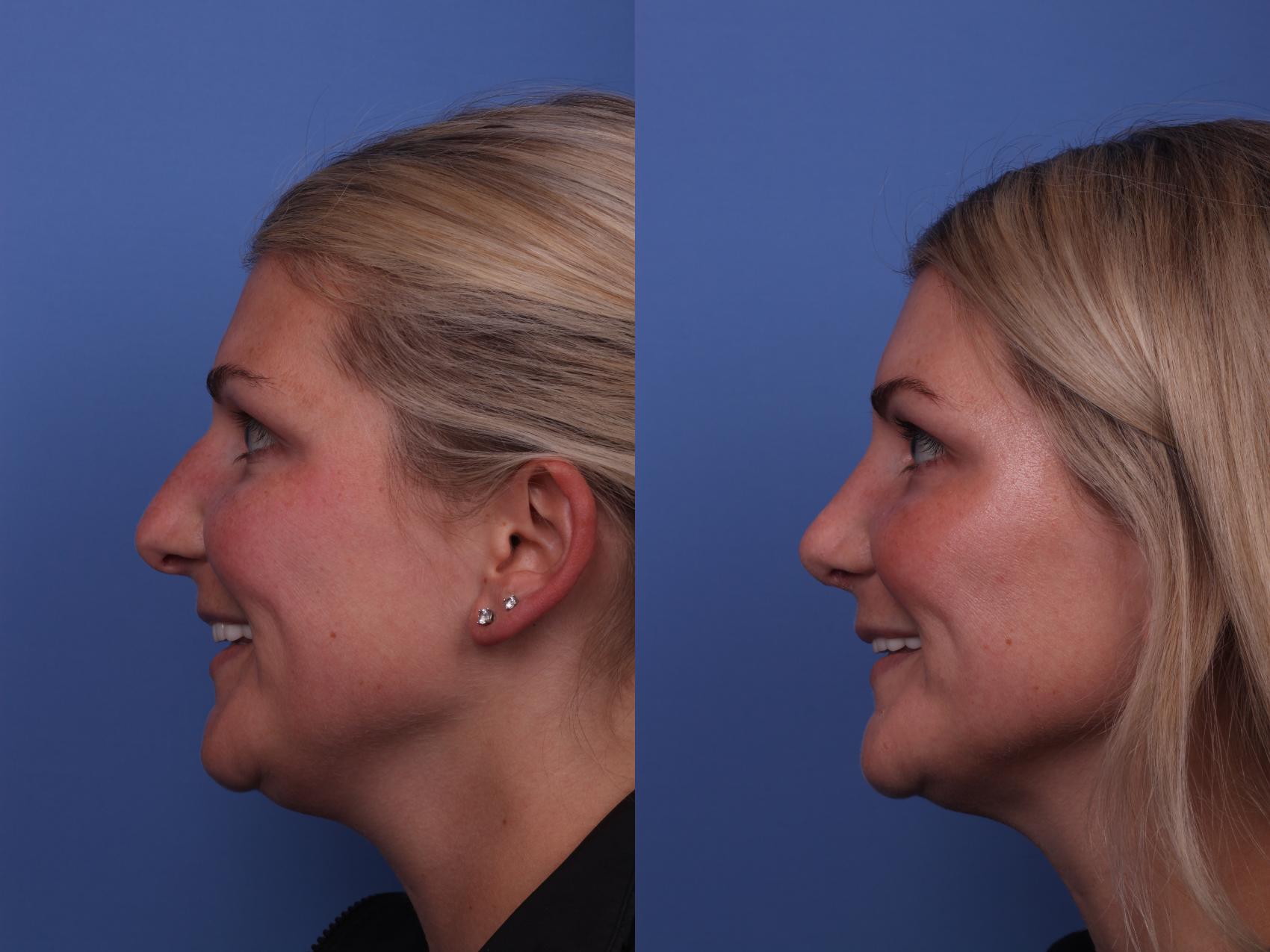Before & After Rhinoplasty Case 327 View #2 View in Scottsdale, AZ