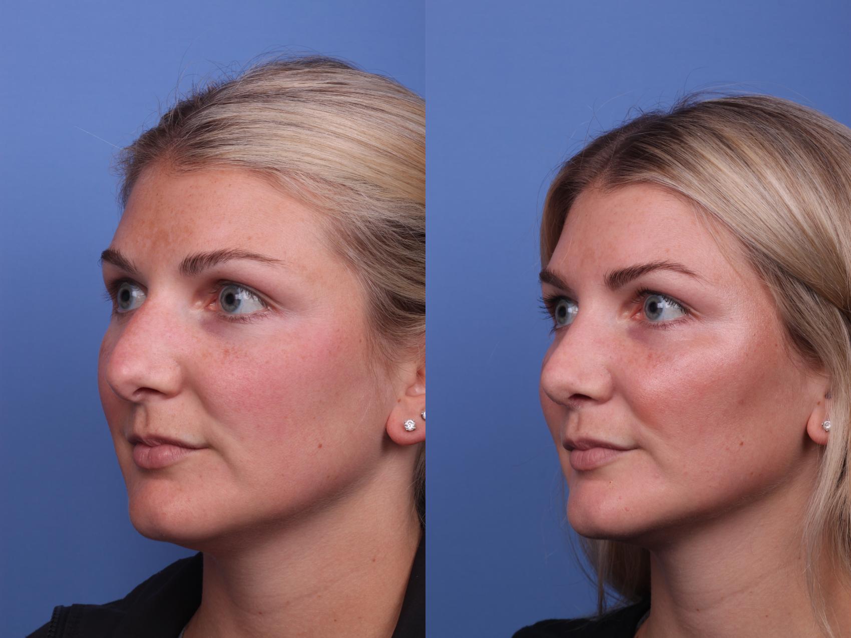 Before & After Rhinoplasty Case 327 View #3 View in Scottsdale, AZ
