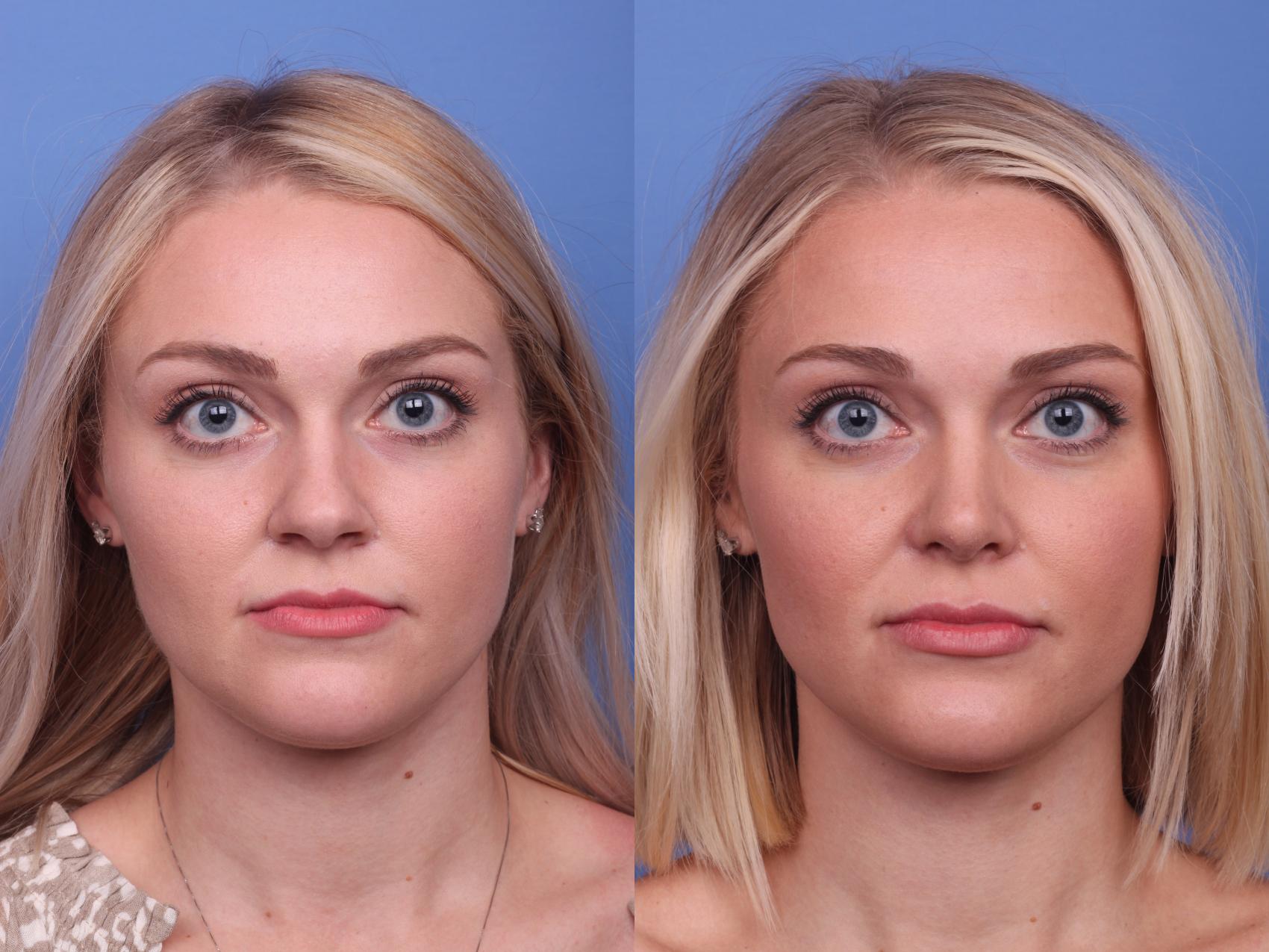 Before & After Rhinoplasty Case 329 View #1 View in Scottsdale, AZ