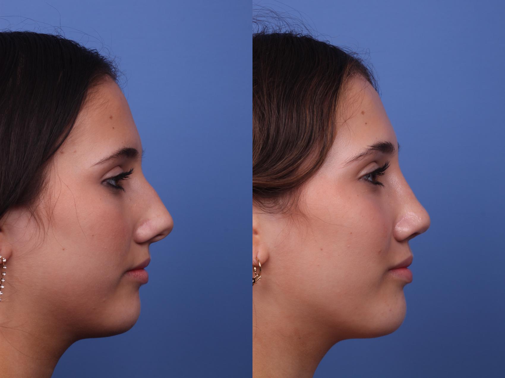 Before & After Rhinoplasty Case 330 View #3 View in Scottsdale, AZ