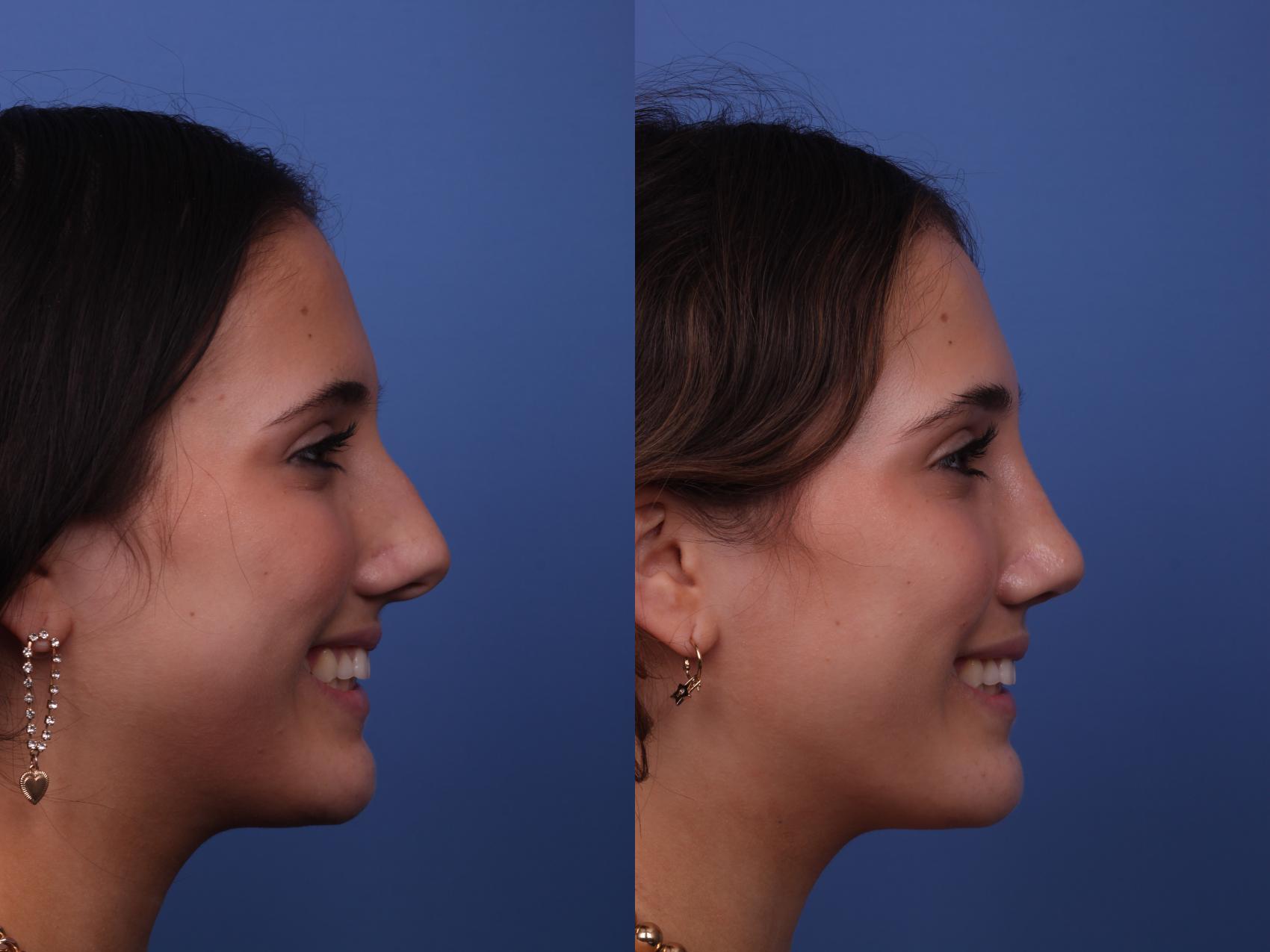 Before & After Rhinoplasty Case 330 View #4 View in Scottsdale, AZ