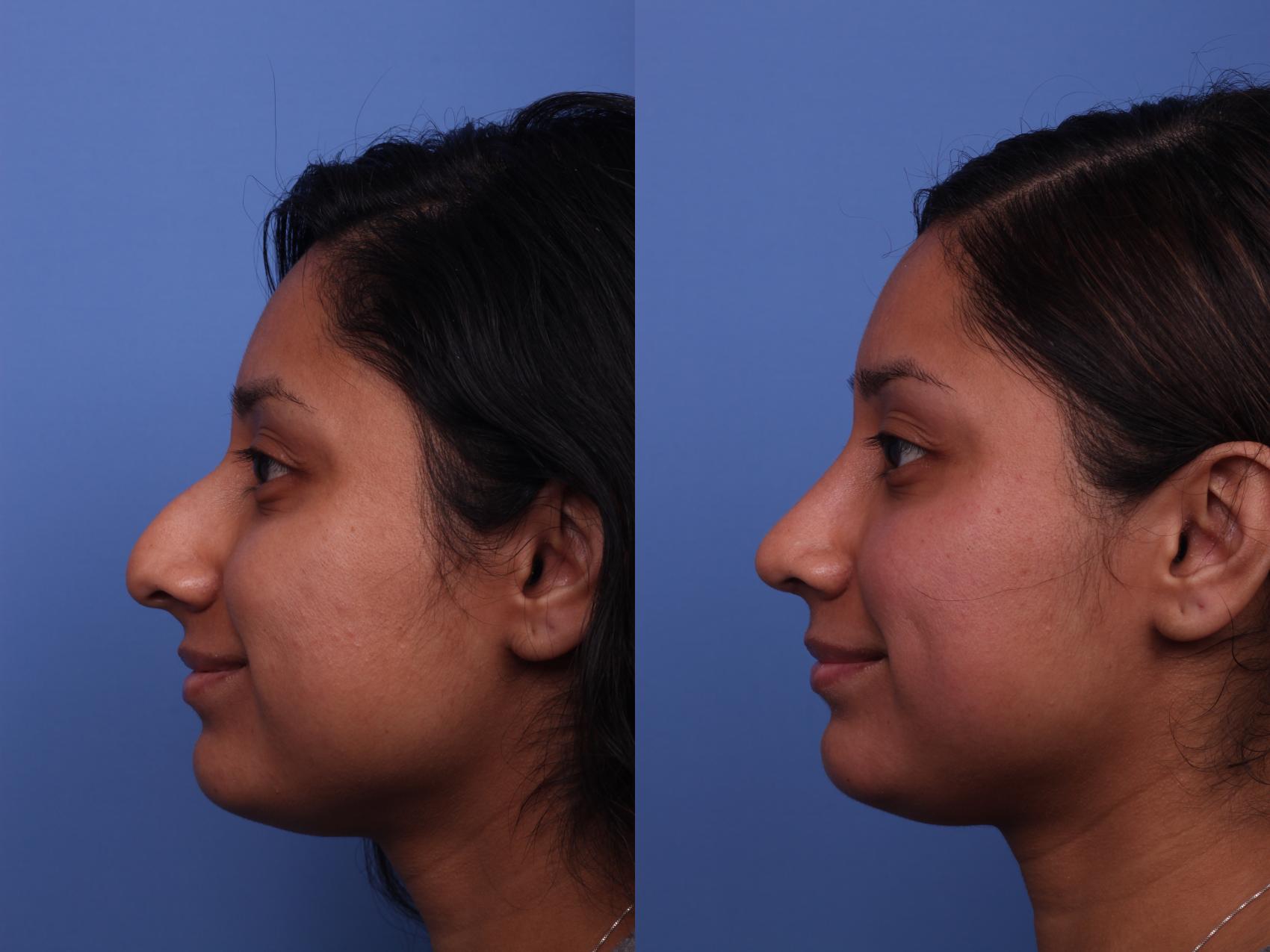 Before & After Rhinoplasty Case 331 View #2 View in Scottsdale, AZ