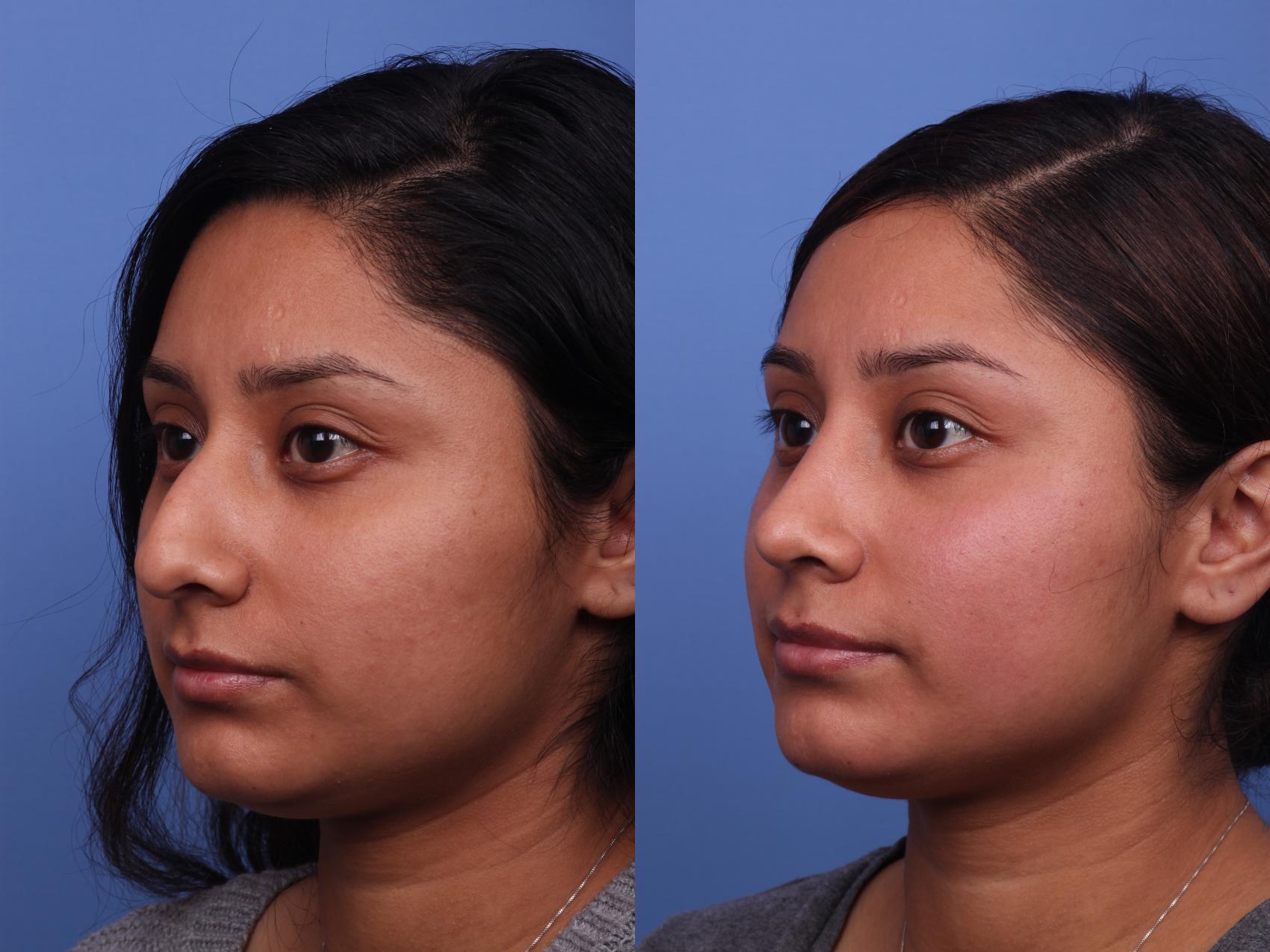 Before & After Rhinoplasty Case 331 View #3 View in Scottsdale, AZ