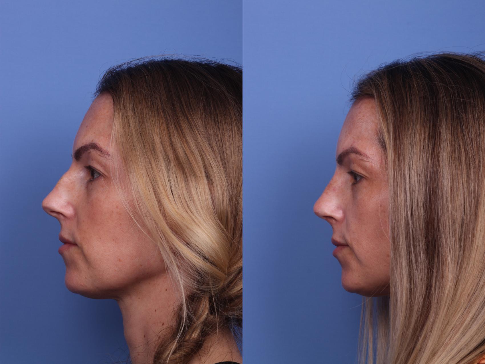 Before & After Rhinoplasty Case 332 View #2 View in Scottsdale, AZ