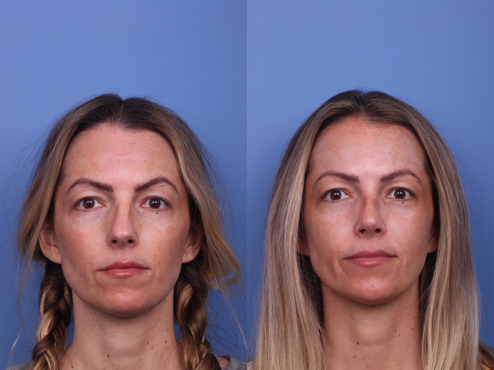 Before & After Rhinoplasty Case 332 View #3 View in Scottsdale, AZ
