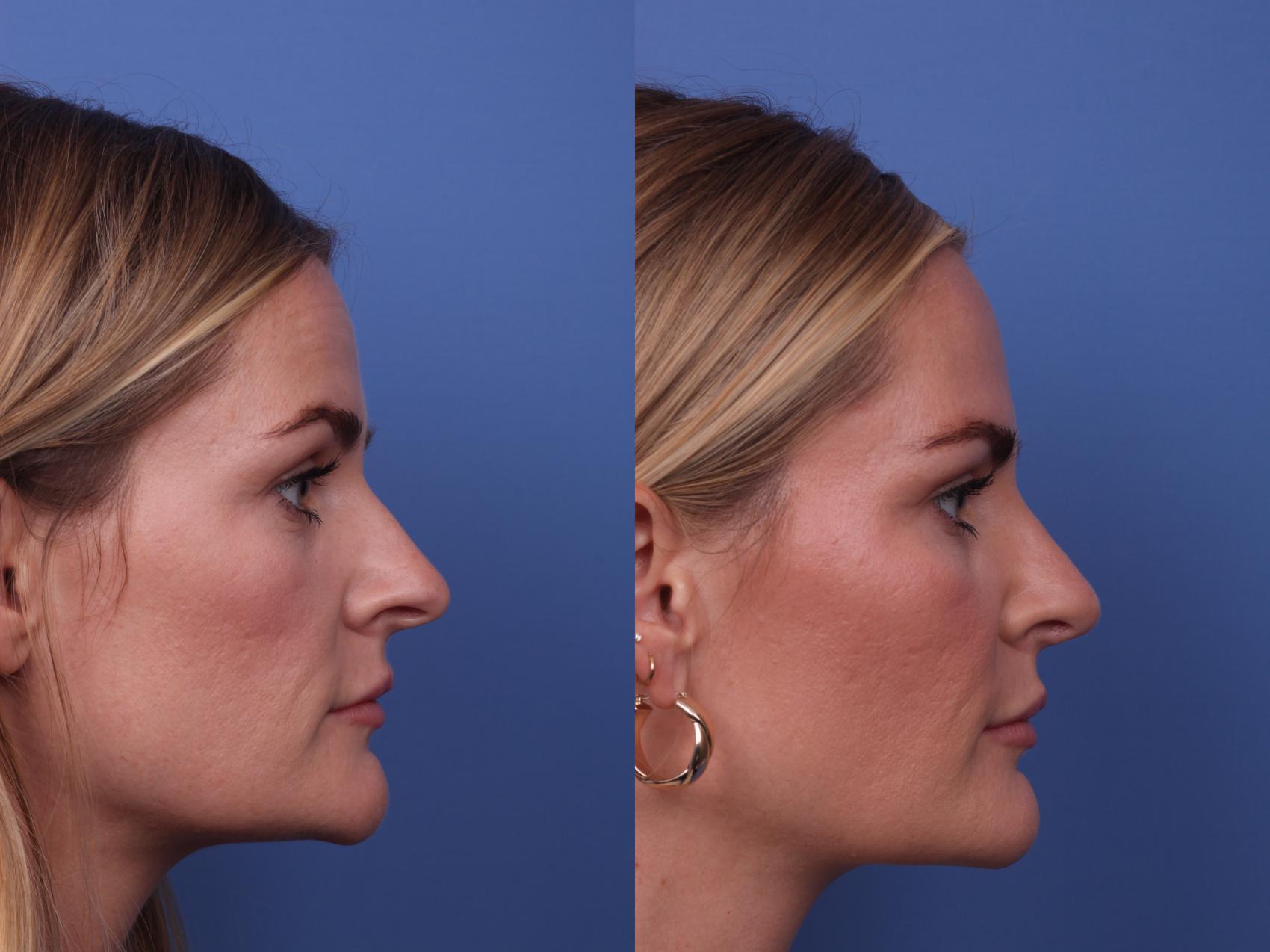 Before & After Rhinoplasty Case 333 View #2 View in Scottsdale, AZ
