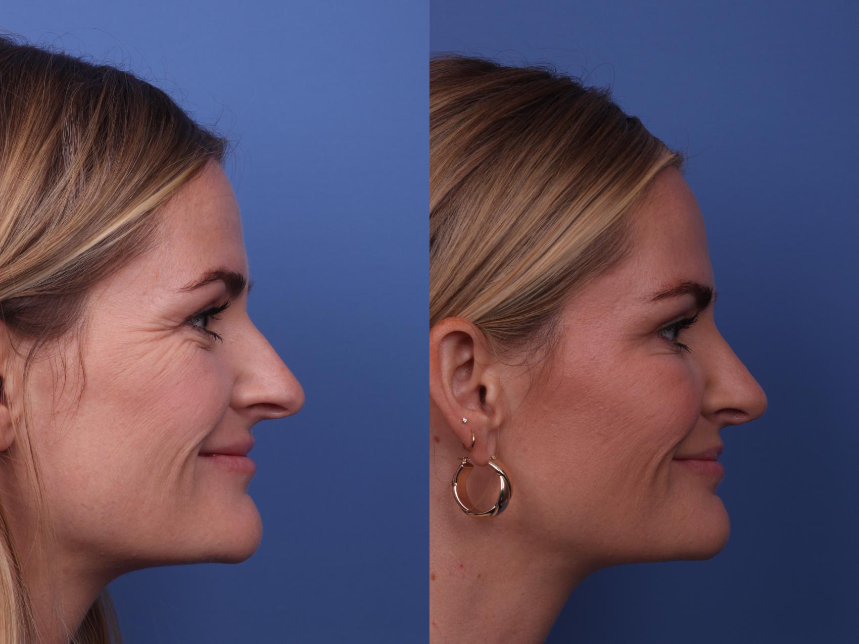 Before & After Rhinoplasty Case 333 View #3 View in Scottsdale, AZ