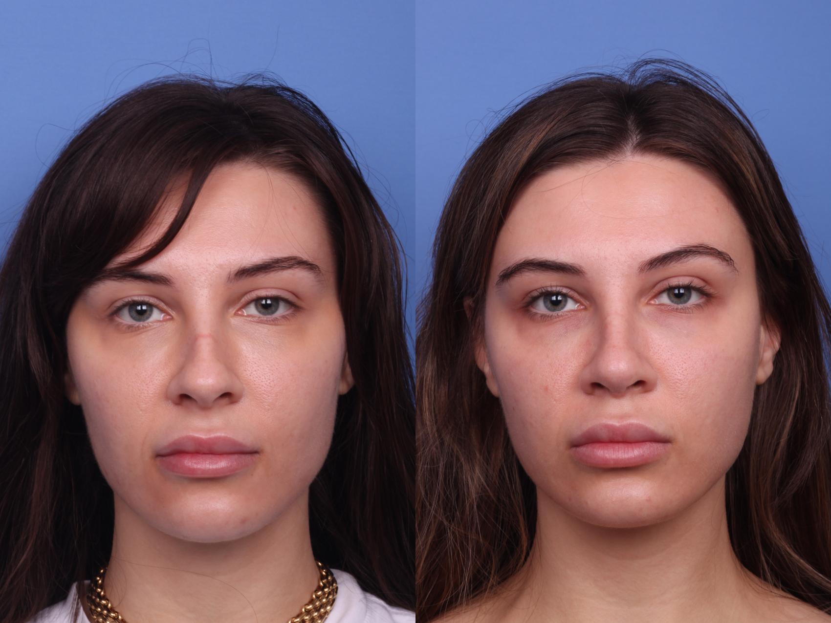 Before & After Rhinoplasty Case 335 View #2 View in Scottsdale, AZ