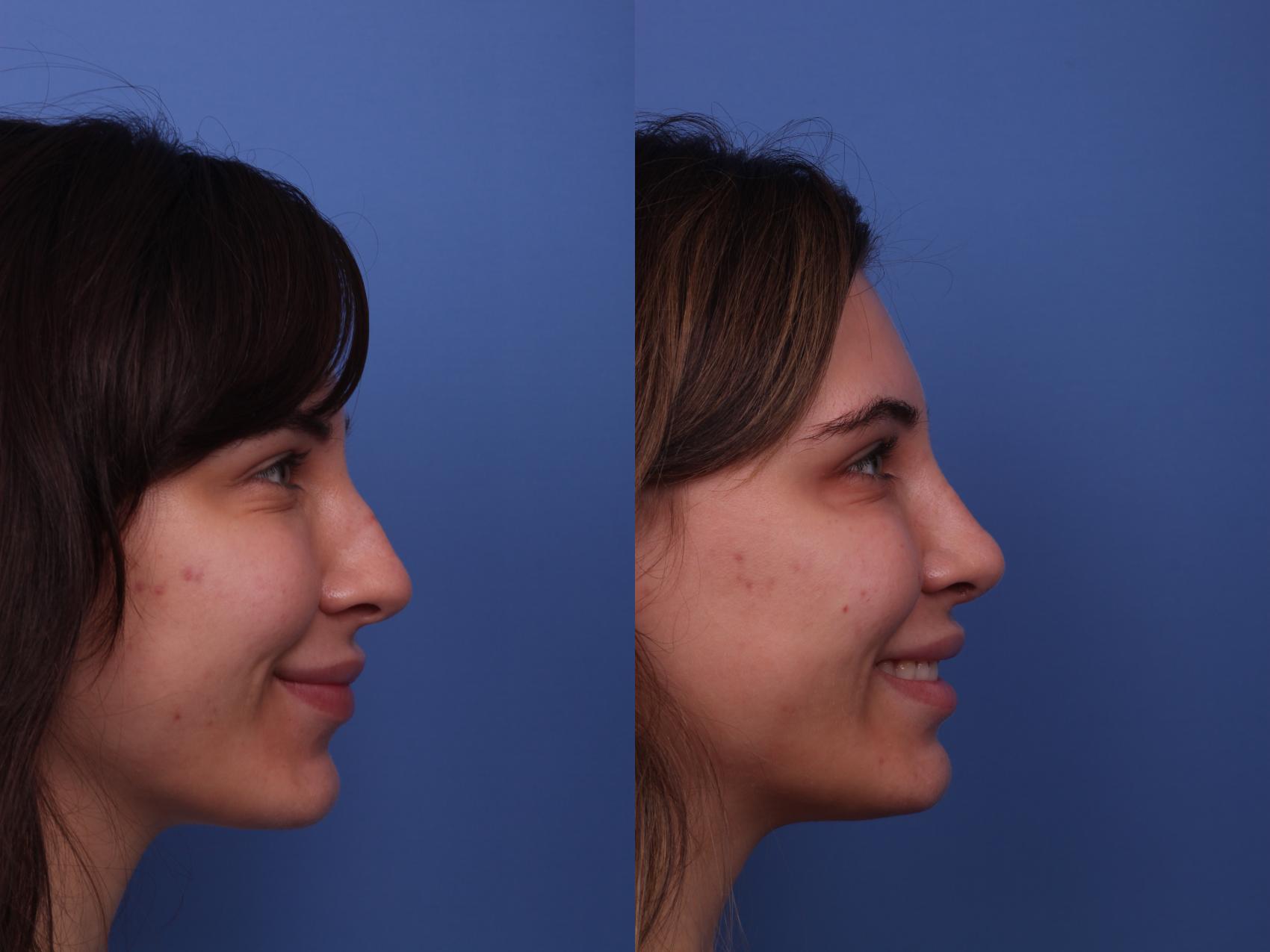 Before & After Rhinoplasty Case 335 View #3 View in Scottsdale, AZ