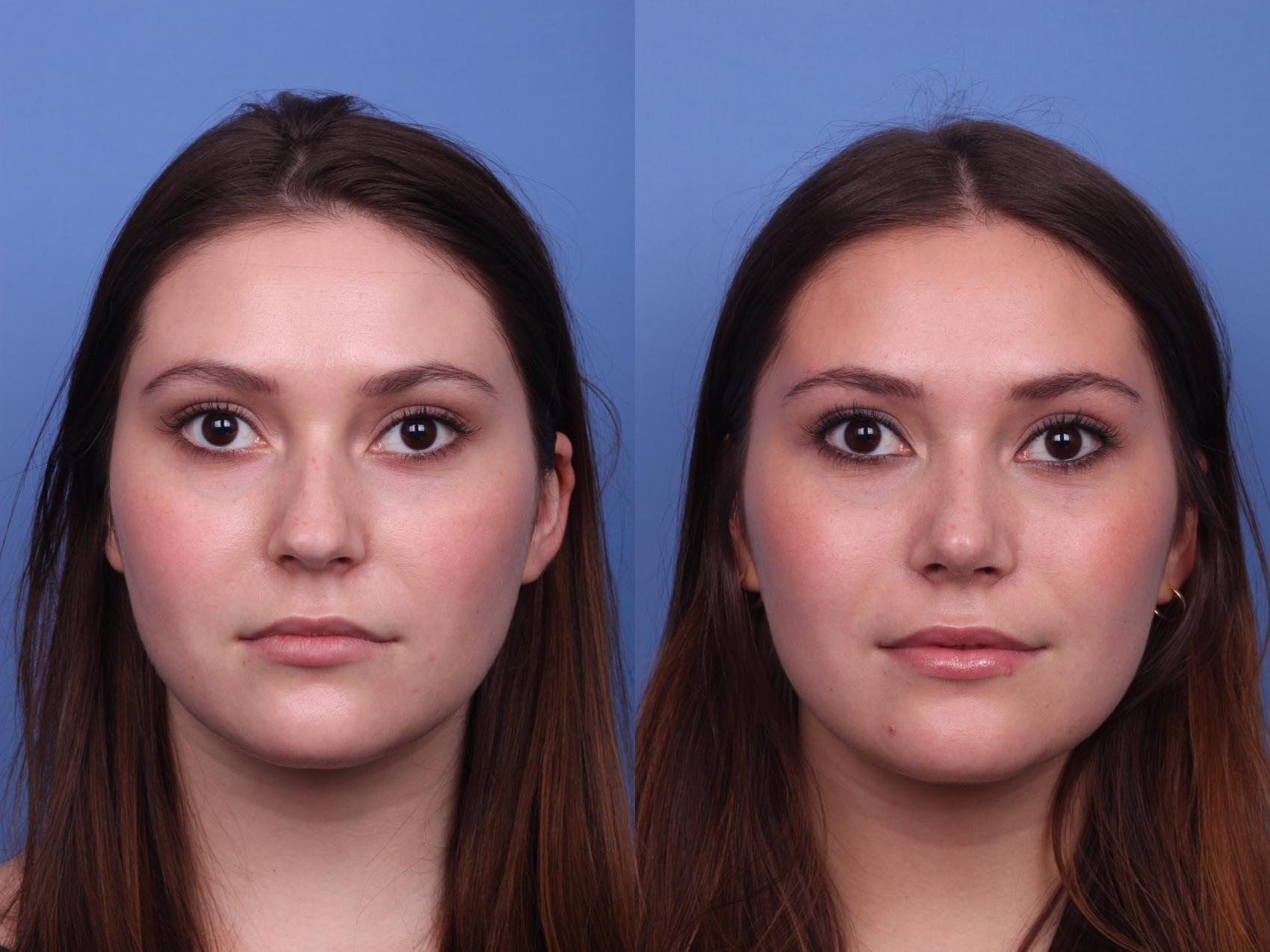 Before & After Rhinoplasty Case 338 Front View in Scottsdale, AZ