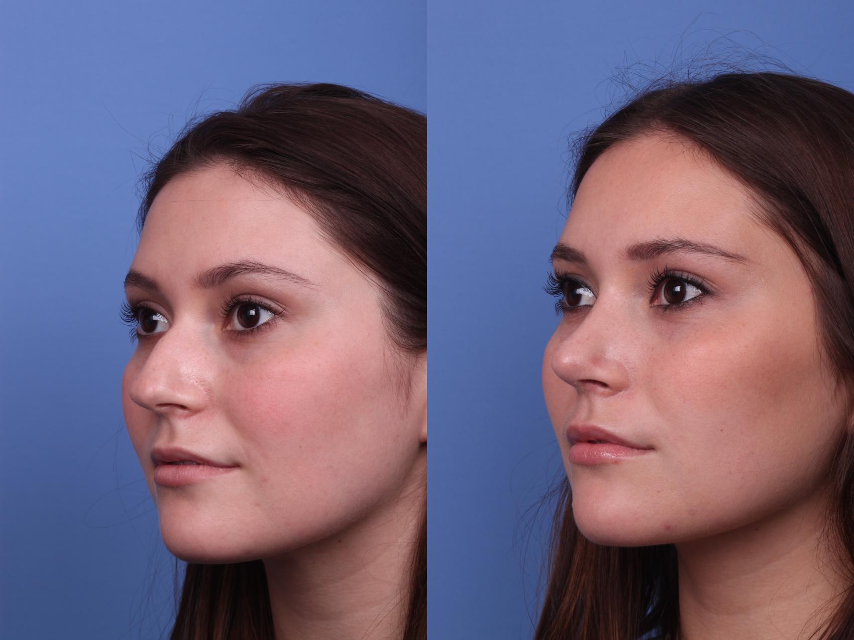 Before & After Rhinoplasty Case 338 Left Oblique View in Scottsdale, AZ