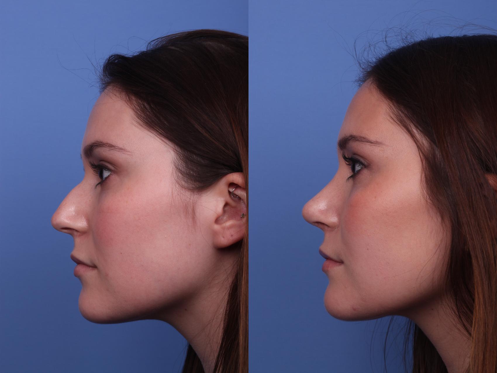 Before & After Rhinoplasty Case 338 Left Side View in Scottsdale, AZ
