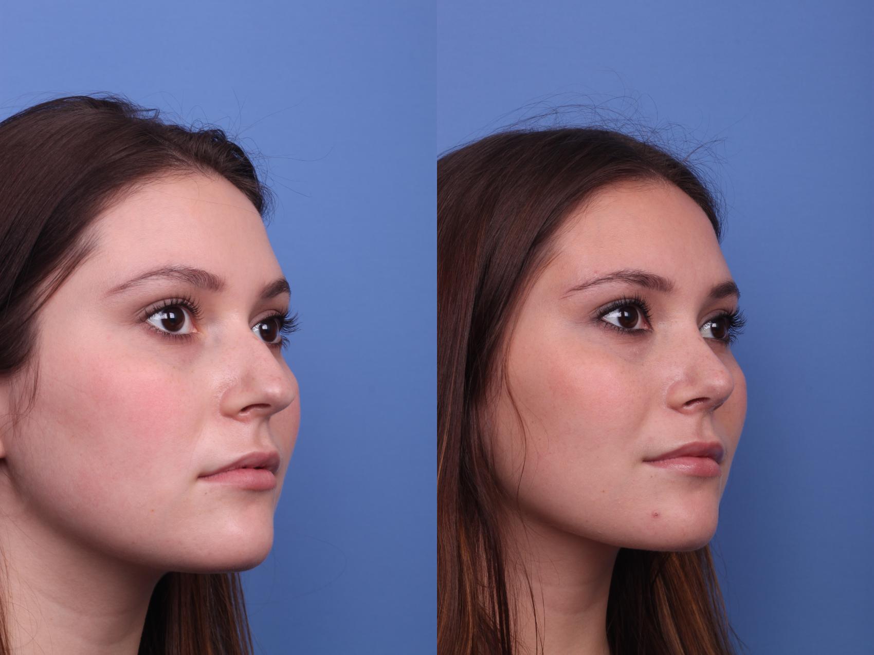 Before & After Rhinoplasty Case 338 Right Oblique View in Scottsdale, AZ