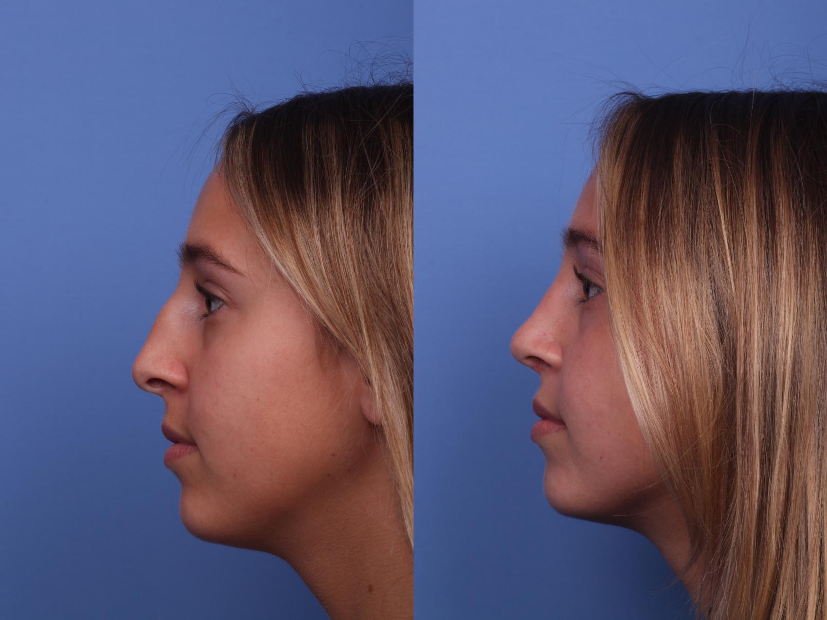 Rhinoplasty Before & After Photo | Scottsdale & Phoenix, AZ | Hobgood Facial Plastic Surgery: Todd Hobgood, MD