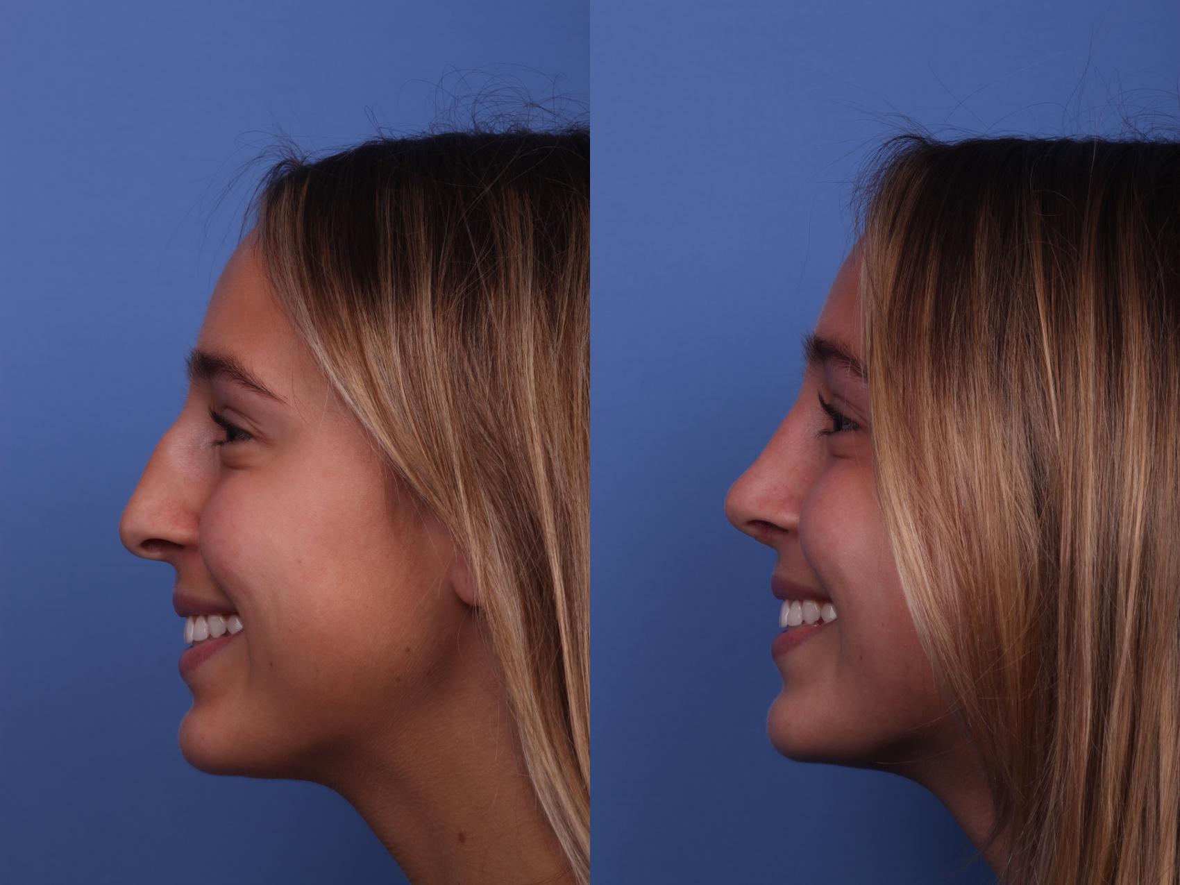 Before & After Rhinoplasty Case 339 Left Smile View in Scottsdale, AZ