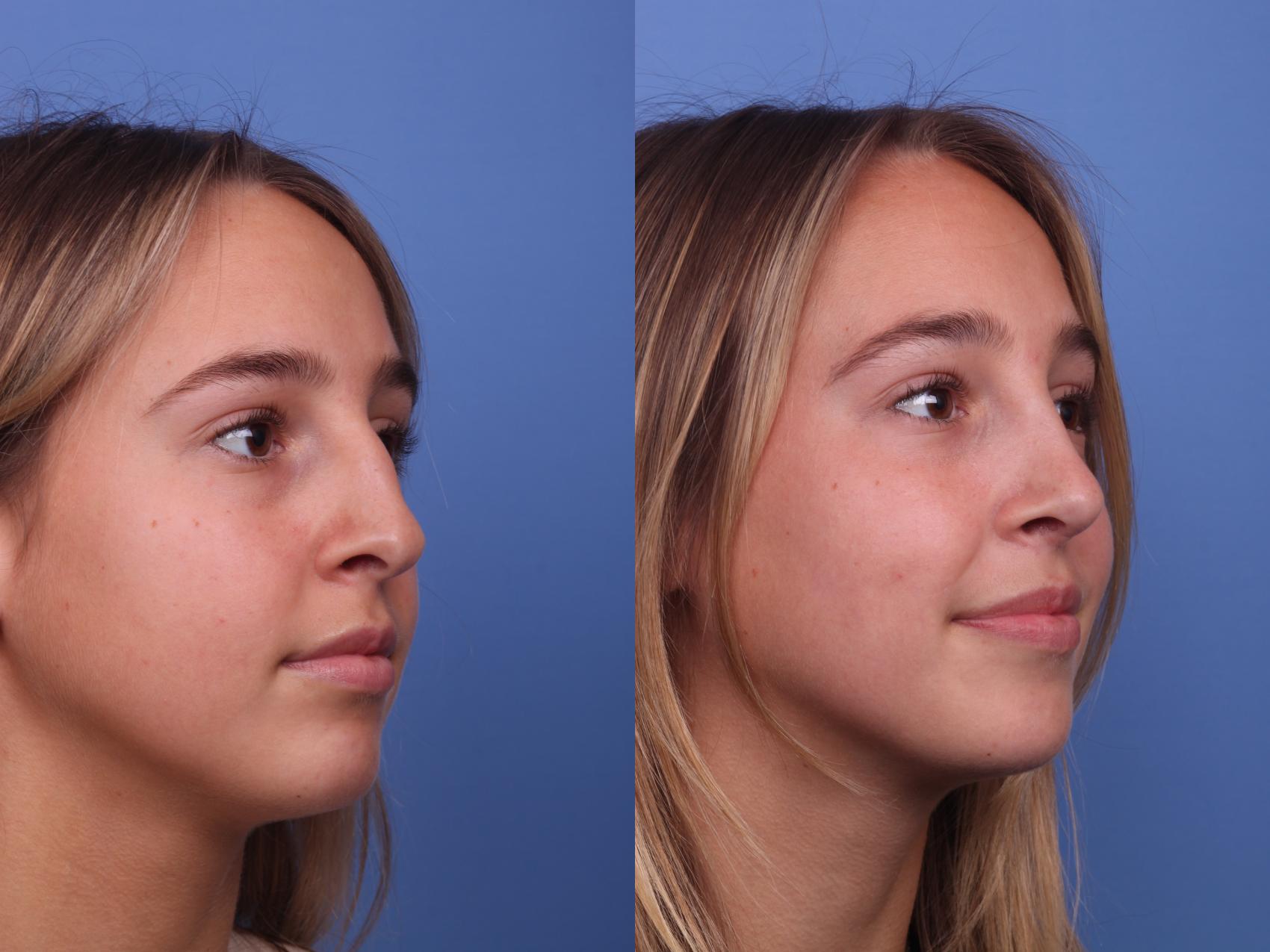 Before & After Rhinoplasty Case 339 Right Oblique View in Scottsdale, AZ