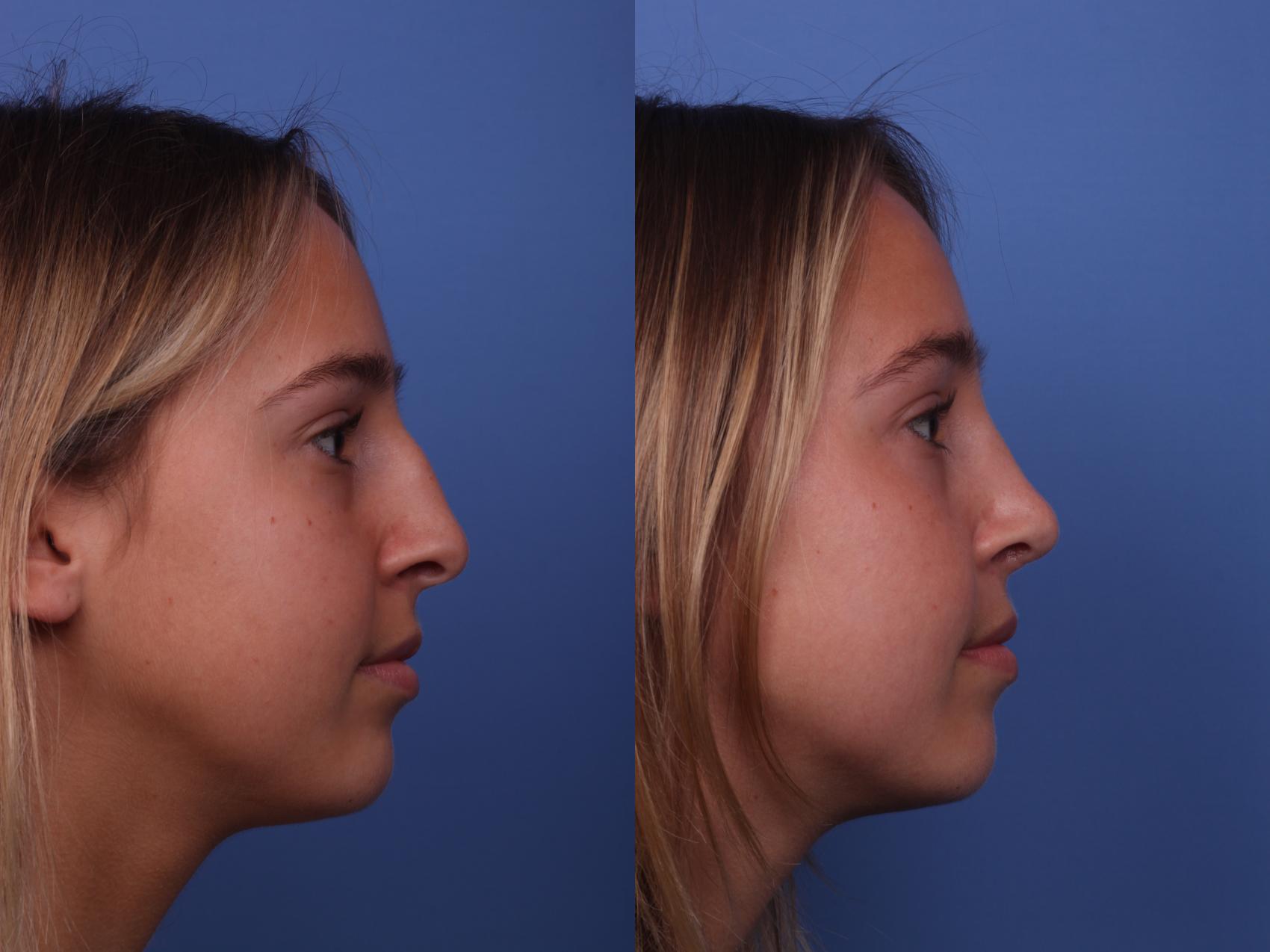 Before & After Rhinoplasty Case 339 Right Side View in Scottsdale, AZ