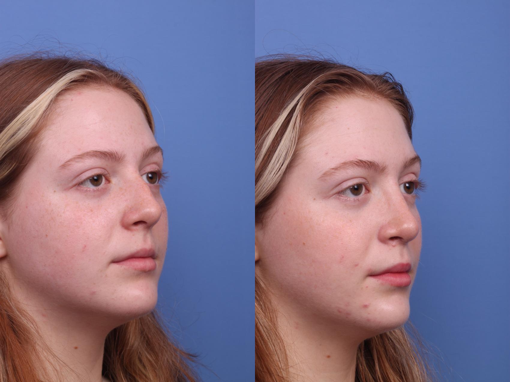 Rhinoplasty Before and After Pictures Case 340 | Scottsdale, AZ ...