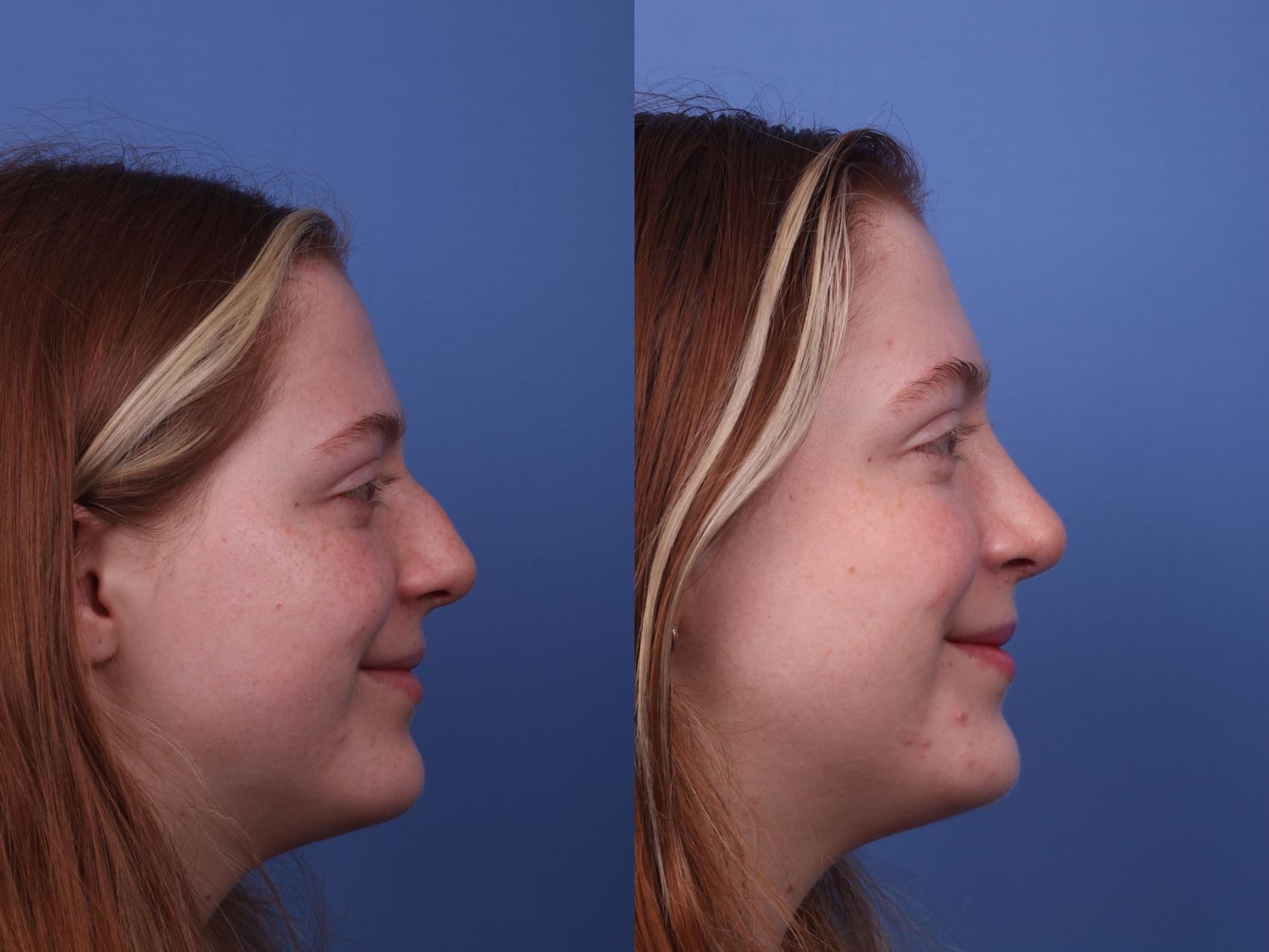 Before & After Rhinoplasty Case 340 Right Smile View in Scottsdale, AZ