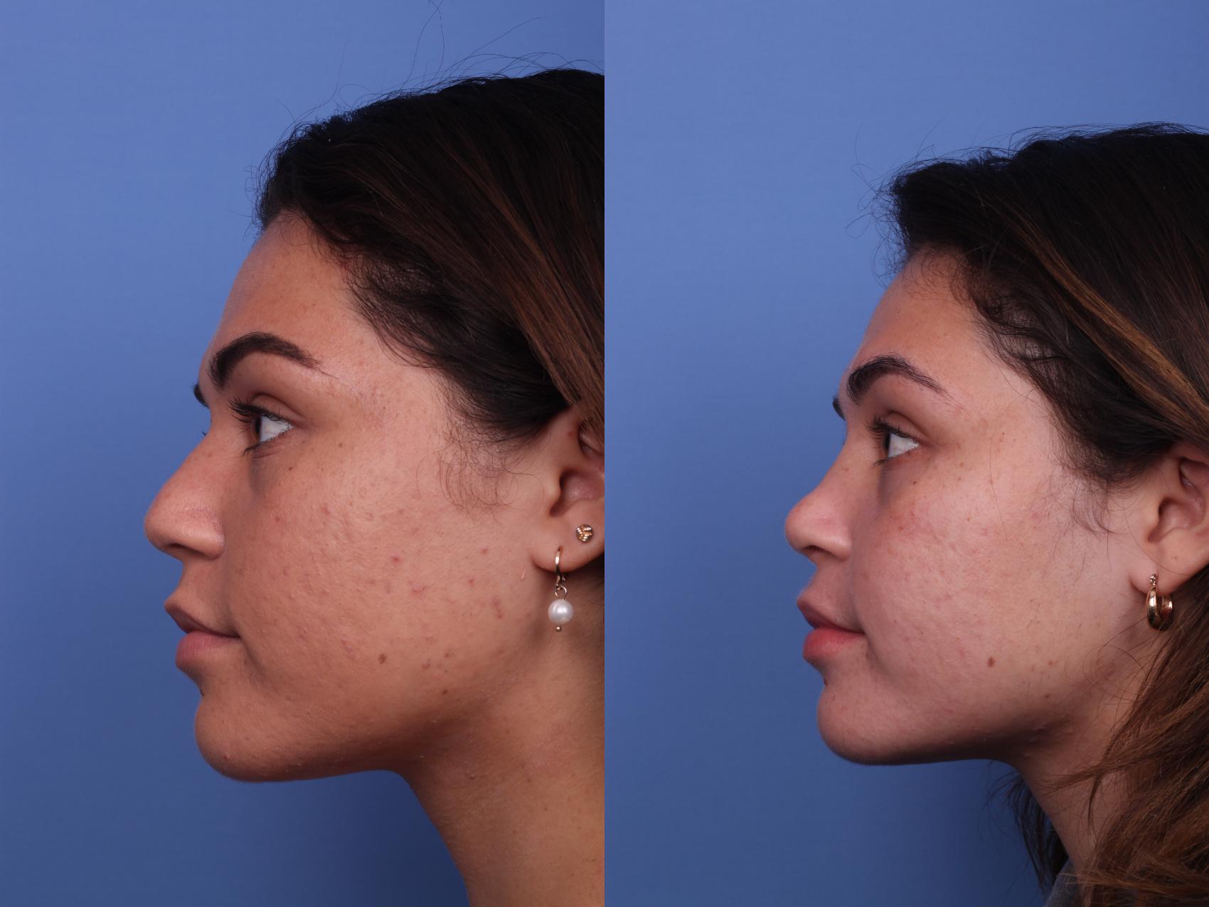 Before & After Rhinoplasty Case 341 Left Side View in Scottsdale, AZ