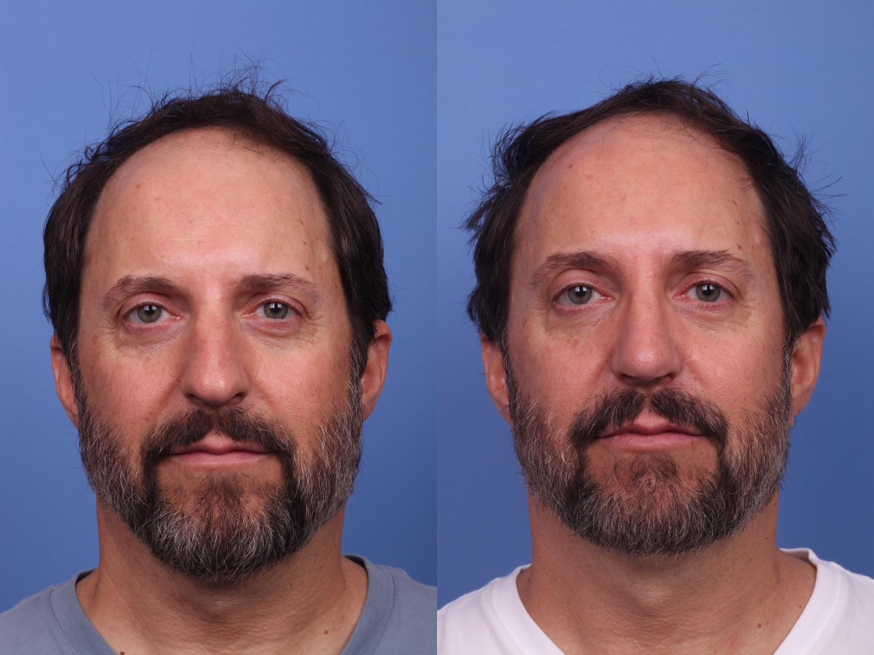 Before & After Rhinoplasty Case 343 Front View in Scottsdale, AZ