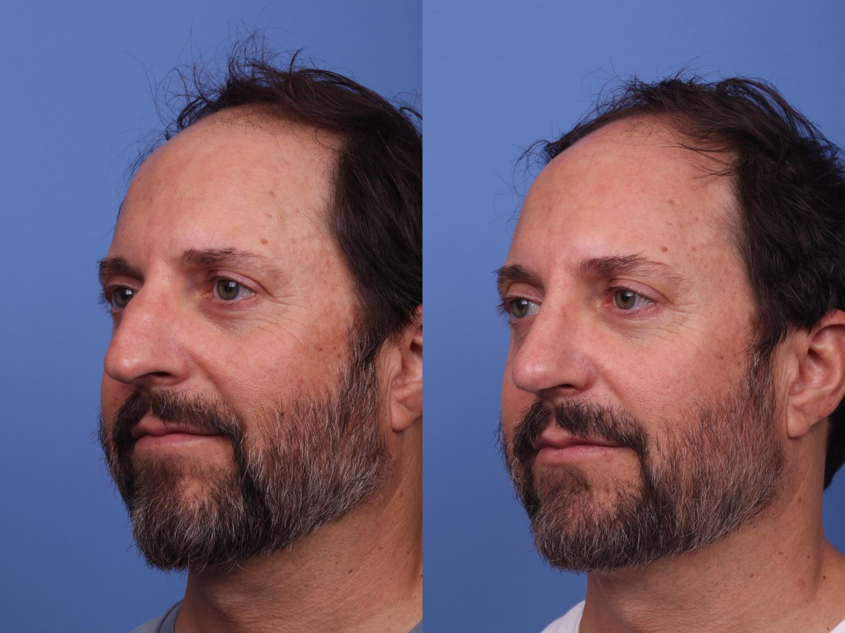 Before & After Rhinoplasty Case 343 Left Oblique View in Scottsdale, AZ