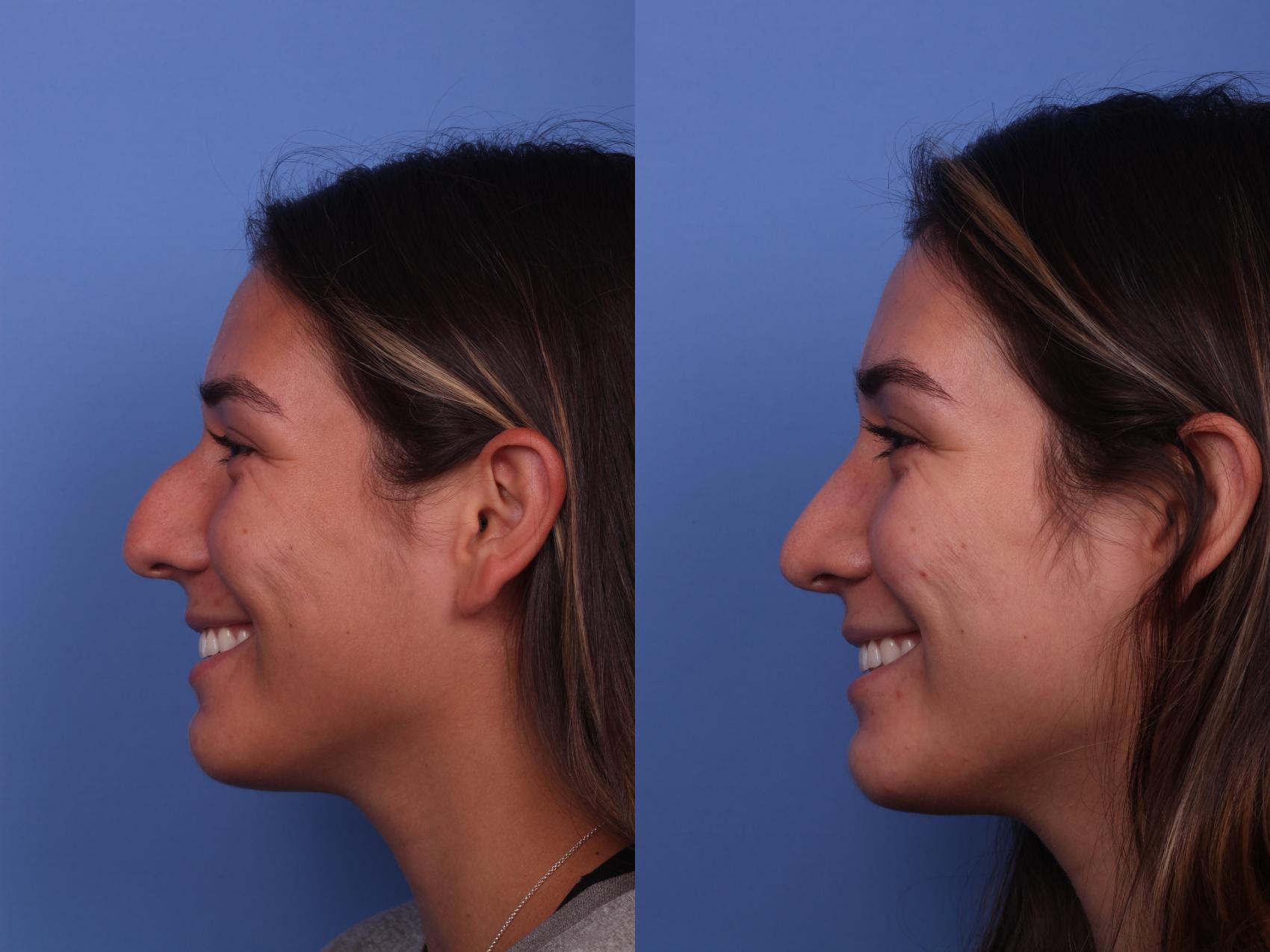 Before & After Rhinoplasty Case 347 Left Smile View in Scottsdale, AZ