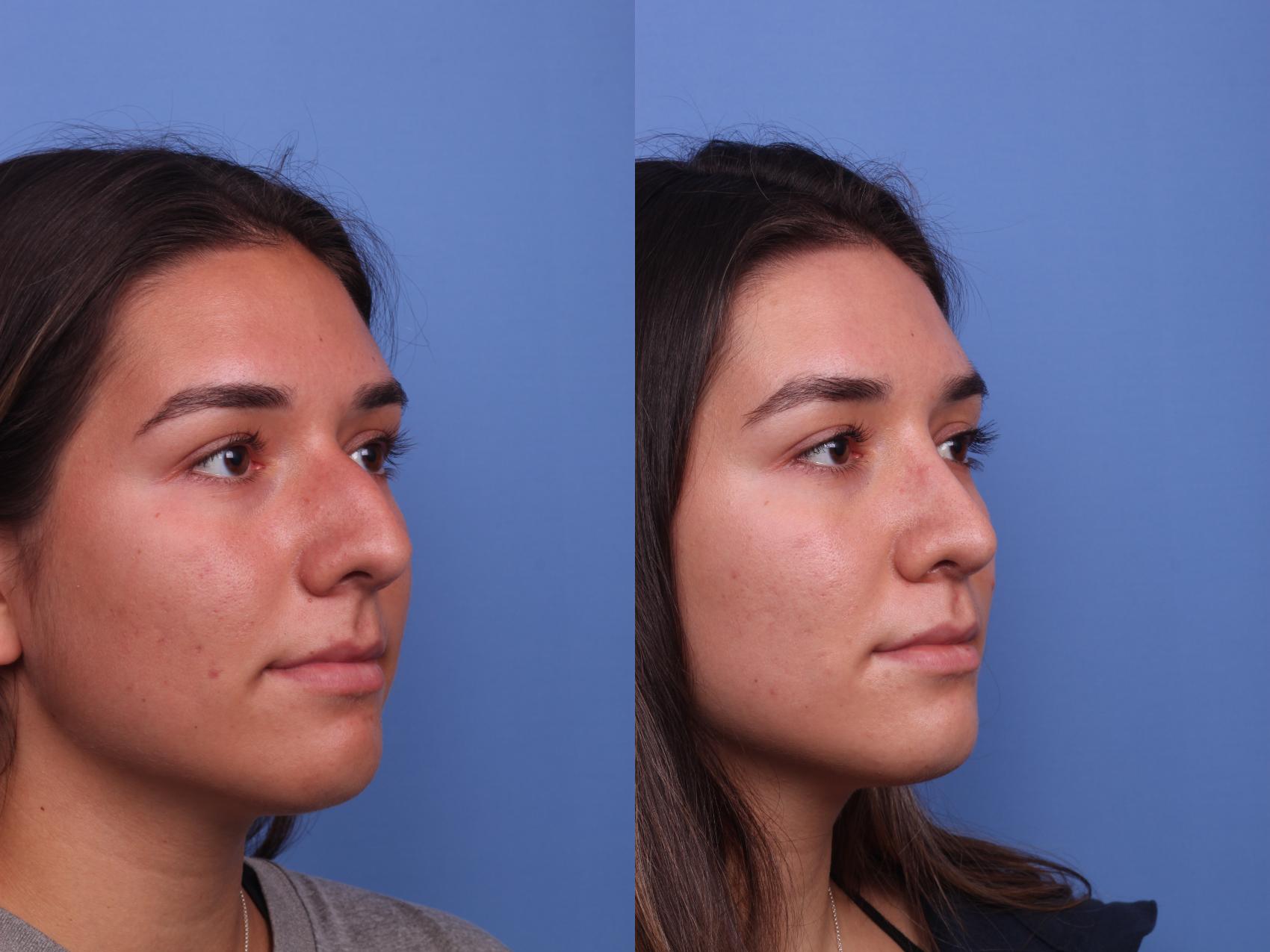Before & After Rhinoplasty Case 347 Right Oblique View in Scottsdale, AZ