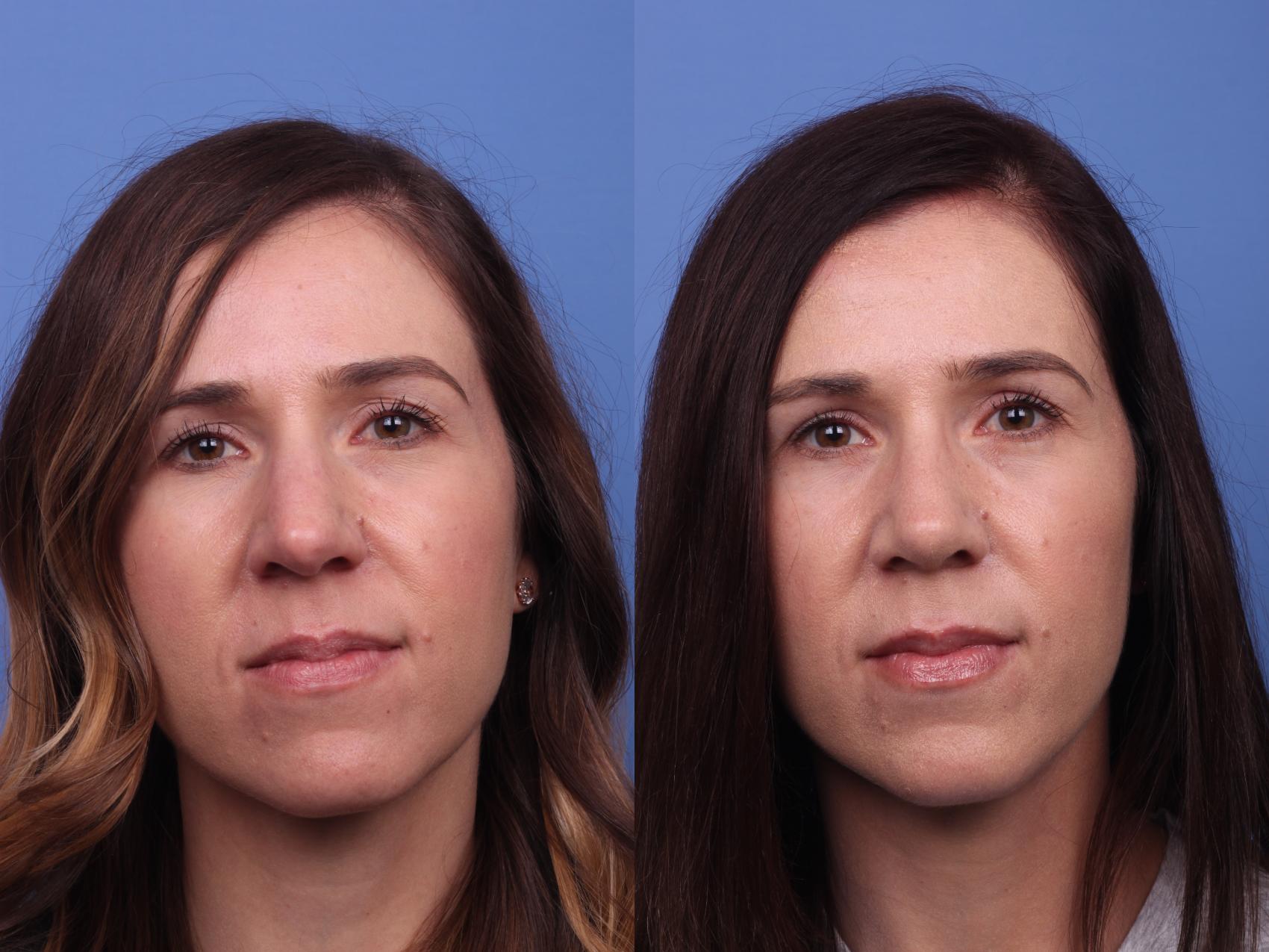 Rhinoplasty Before And After Pictures Case 349 Scottsdale Az Hobgood Facial Plastic Surgery 7751