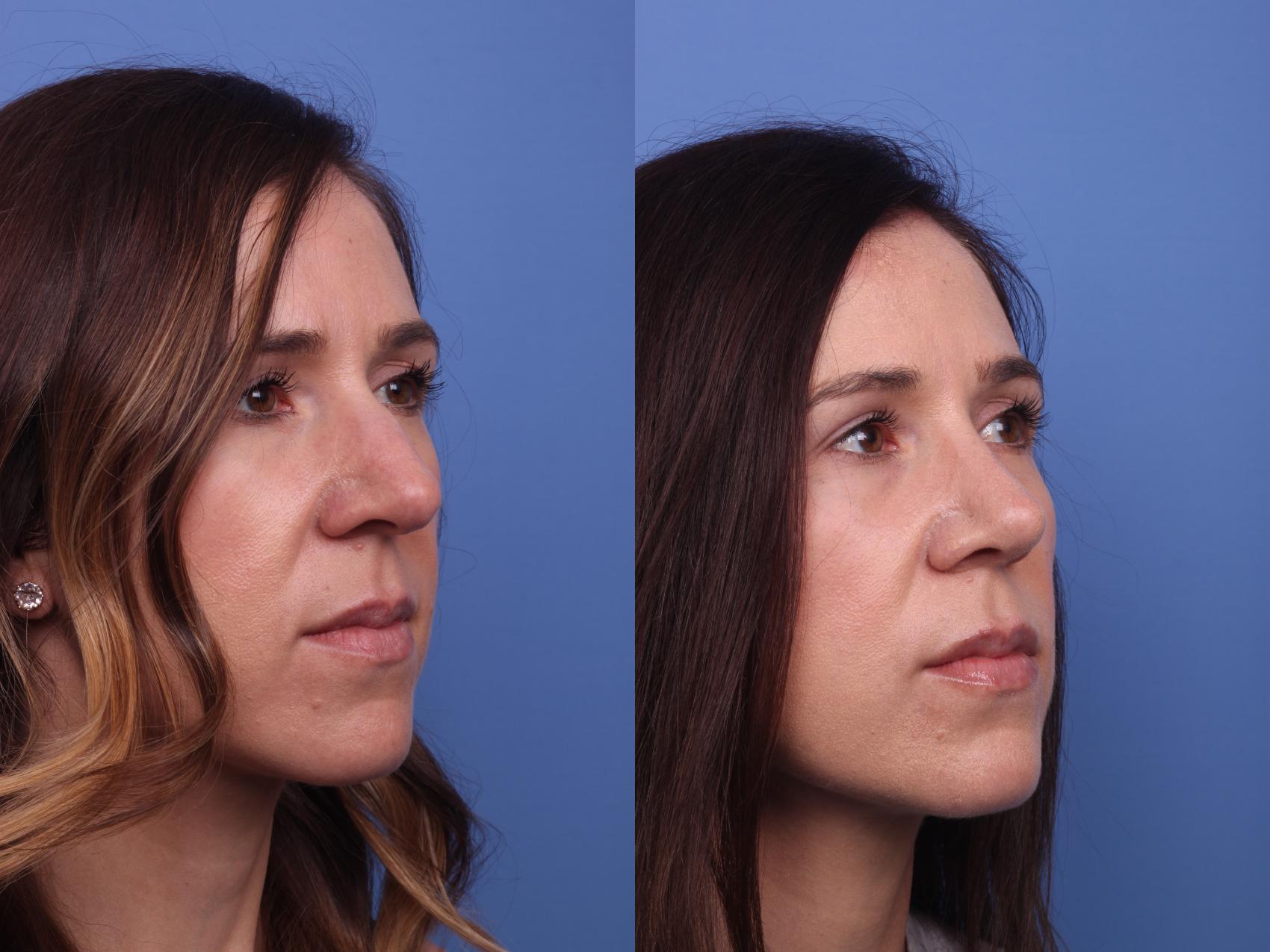 Before & After Rhinoplasty Case 349 Right Oblique View in Scottsdale, AZ