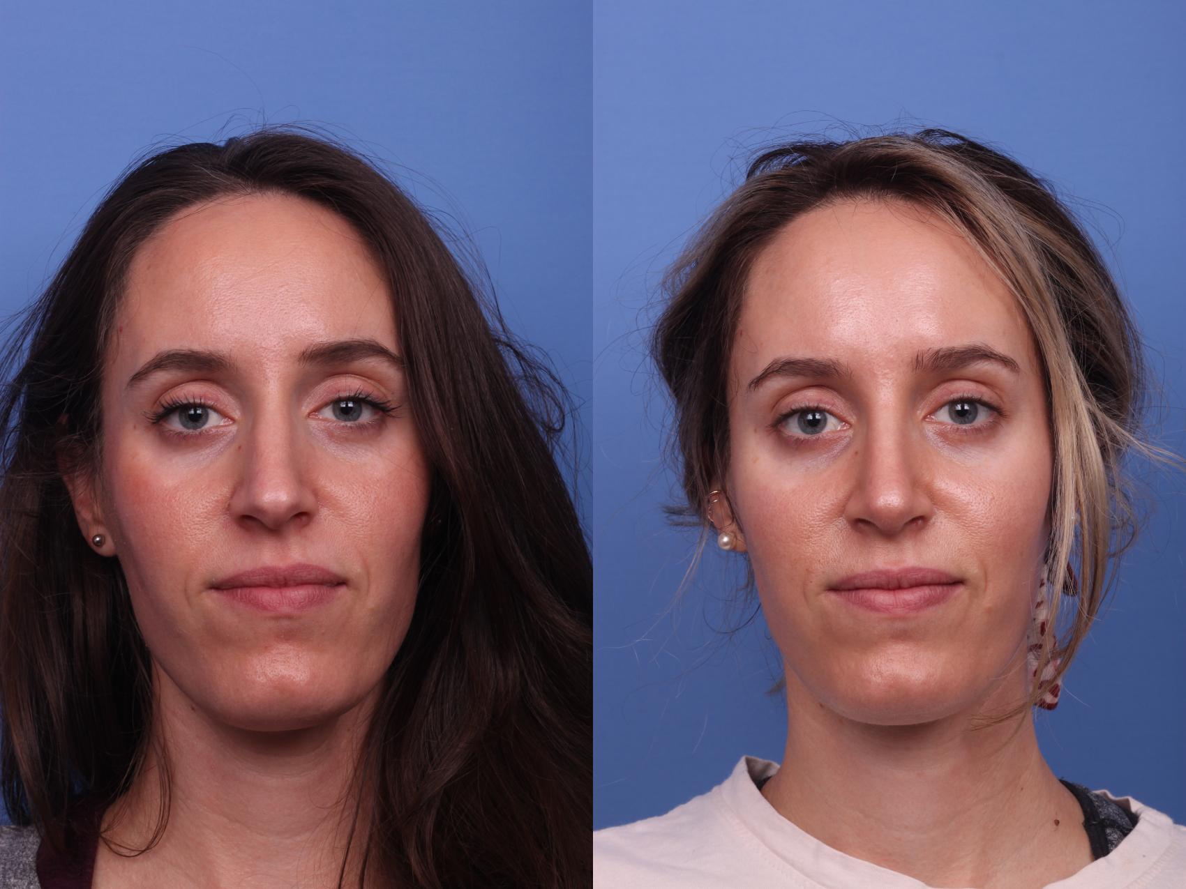 Before & After Rhinoplasty Case 350 Front View in Scottsdale, AZ