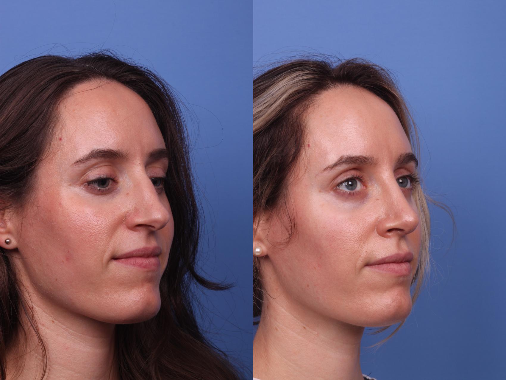 Before & After Rhinoplasty Case 350 Right Oblique View in Scottsdale, AZ