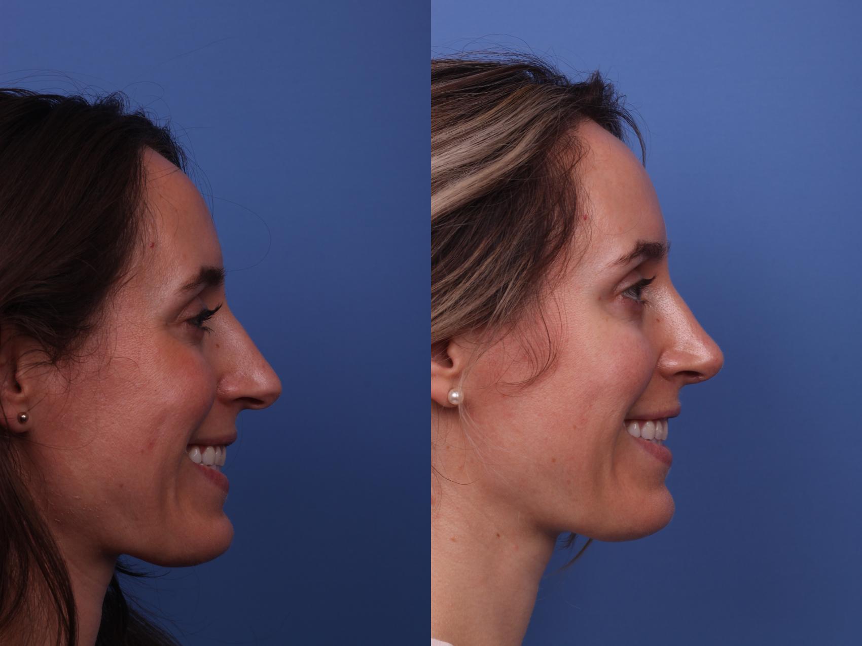 Before & After Rhinoplasty Case 350 Right Smile View in Scottsdale, AZ