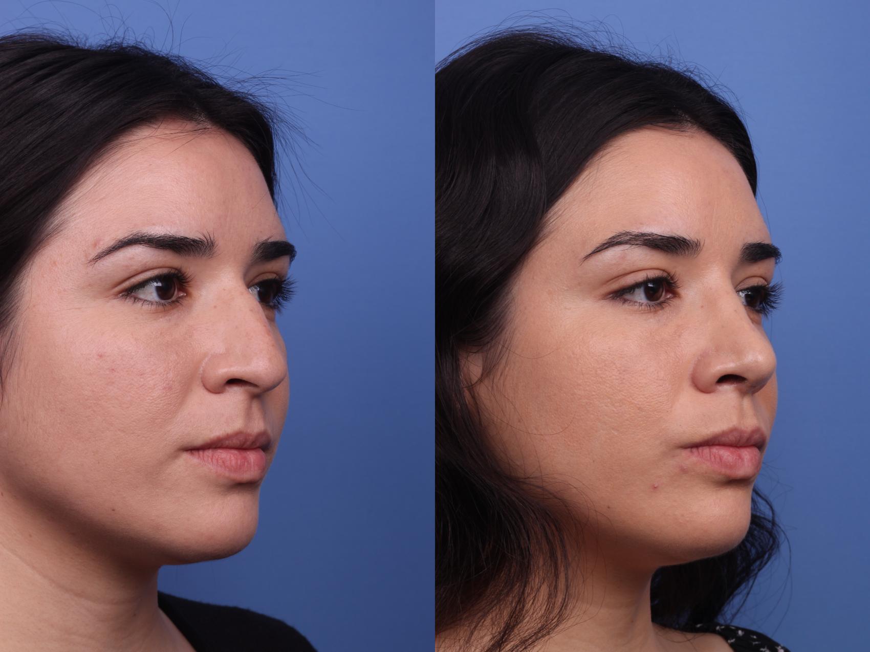 Before & After Rhinoplasty Case 352 Right Oblique View in Scottsdale, AZ