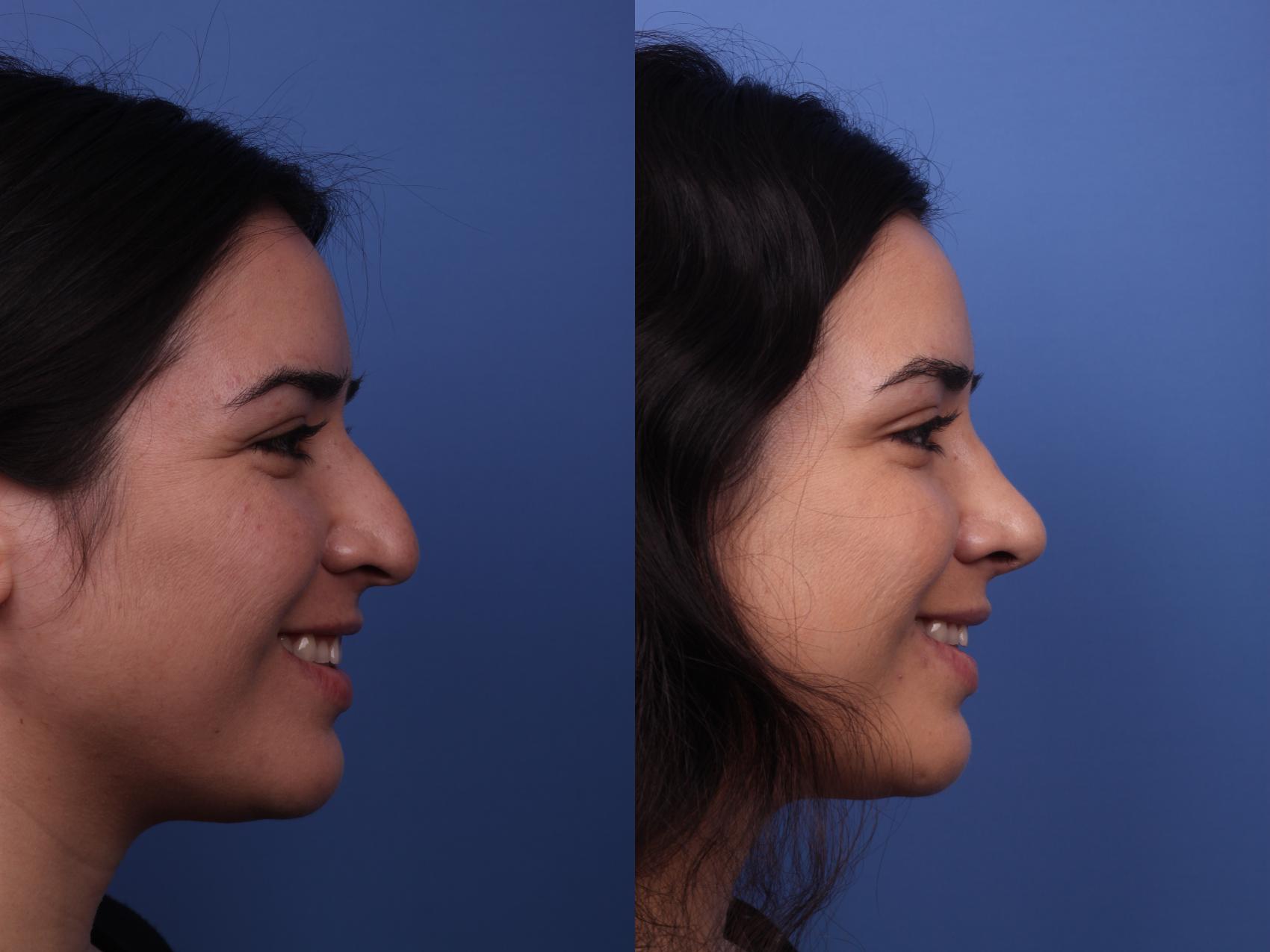 Before & After Rhinoplasty Case 352 Right Smile View in Scottsdale, AZ