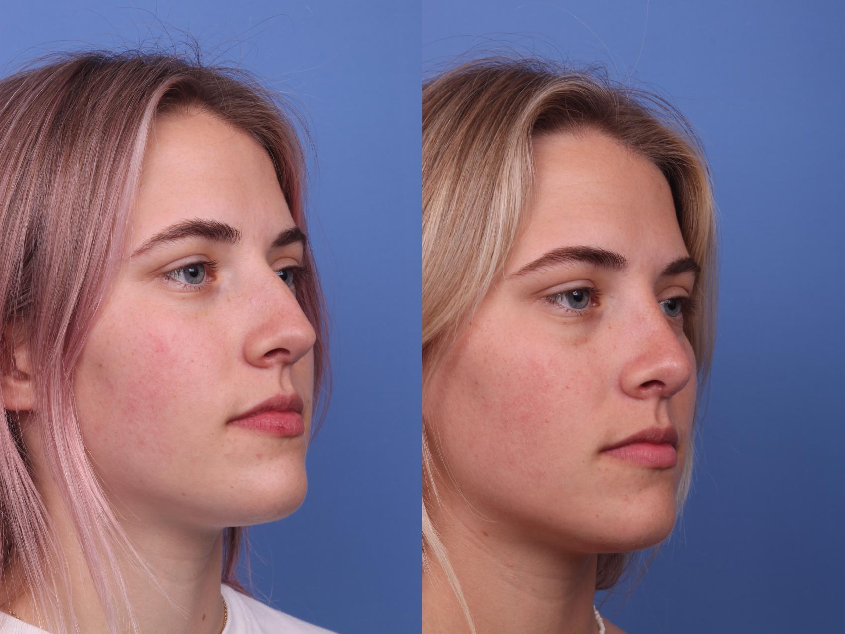 Before & After Rhinoplasty Case 353 Right Oblique View in Scottsdale, AZ