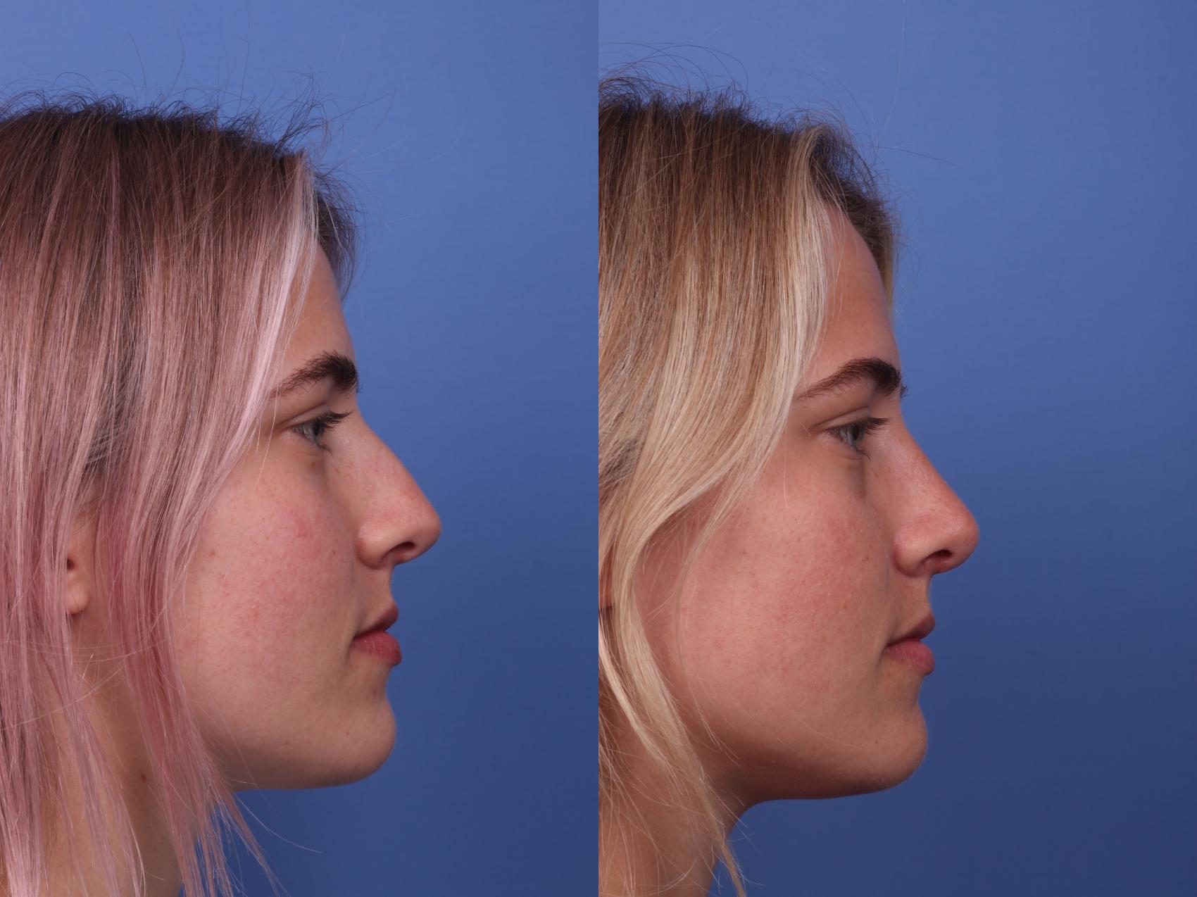 Rhinoplasty Before & After Photo | Scottsdale & Phoenix, AZ | Hobgood Facial Plastic Surgery: Todd Hobgood, MD