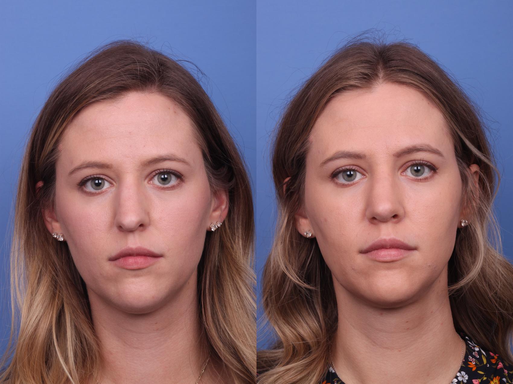 Before & After Rhinoplasty Case 354 Front View in Scottsdale, AZ