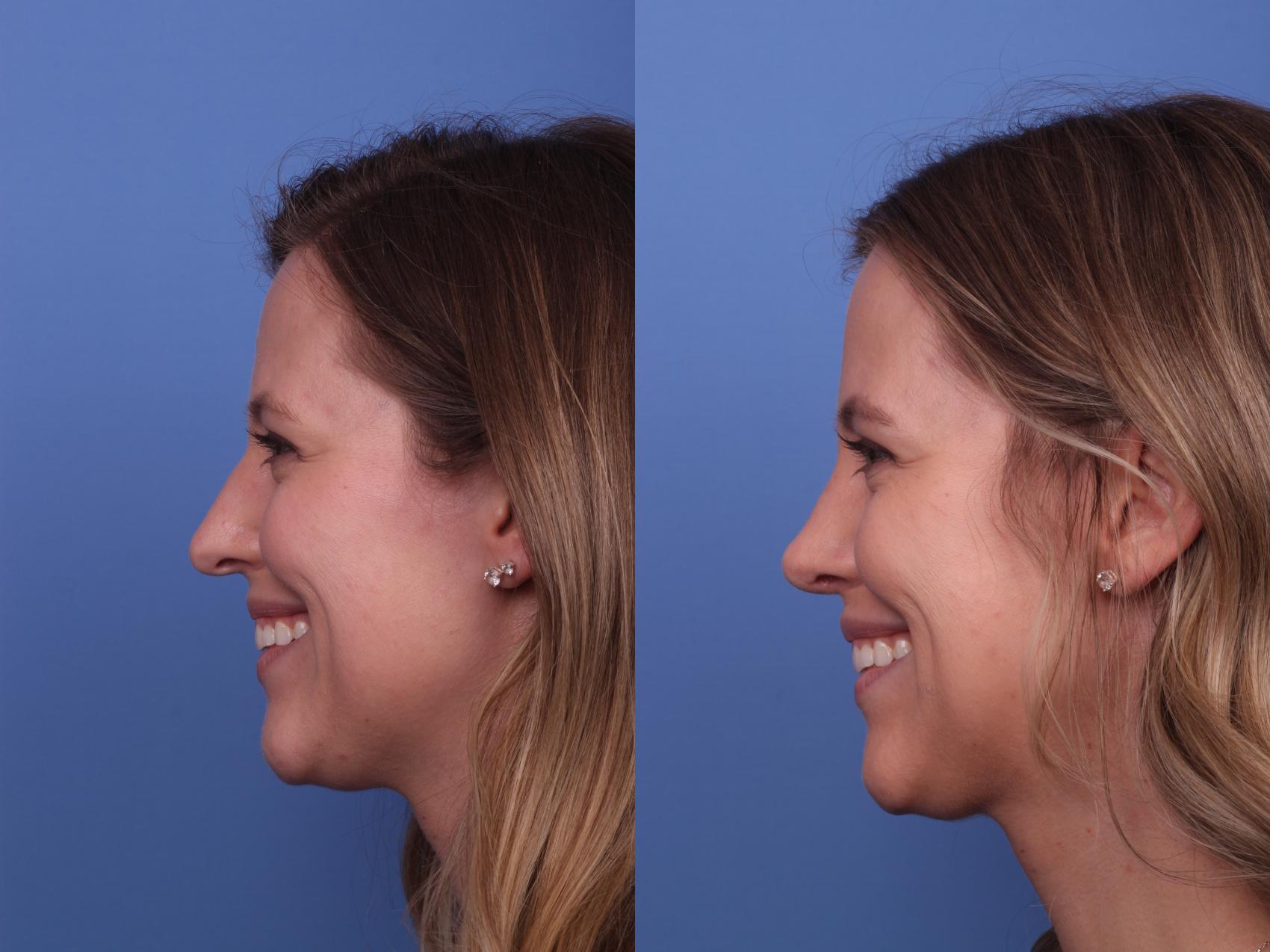 Before & After Rhinoplasty Case 354 Left Smile View in Scottsdale, AZ