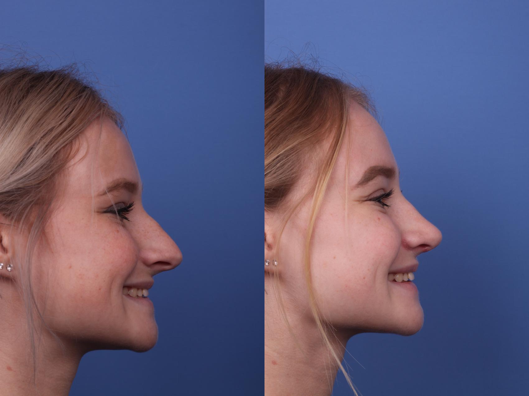 Before & After Rhinoplasty Case 355 Right Smile View in Scottsdale, AZ